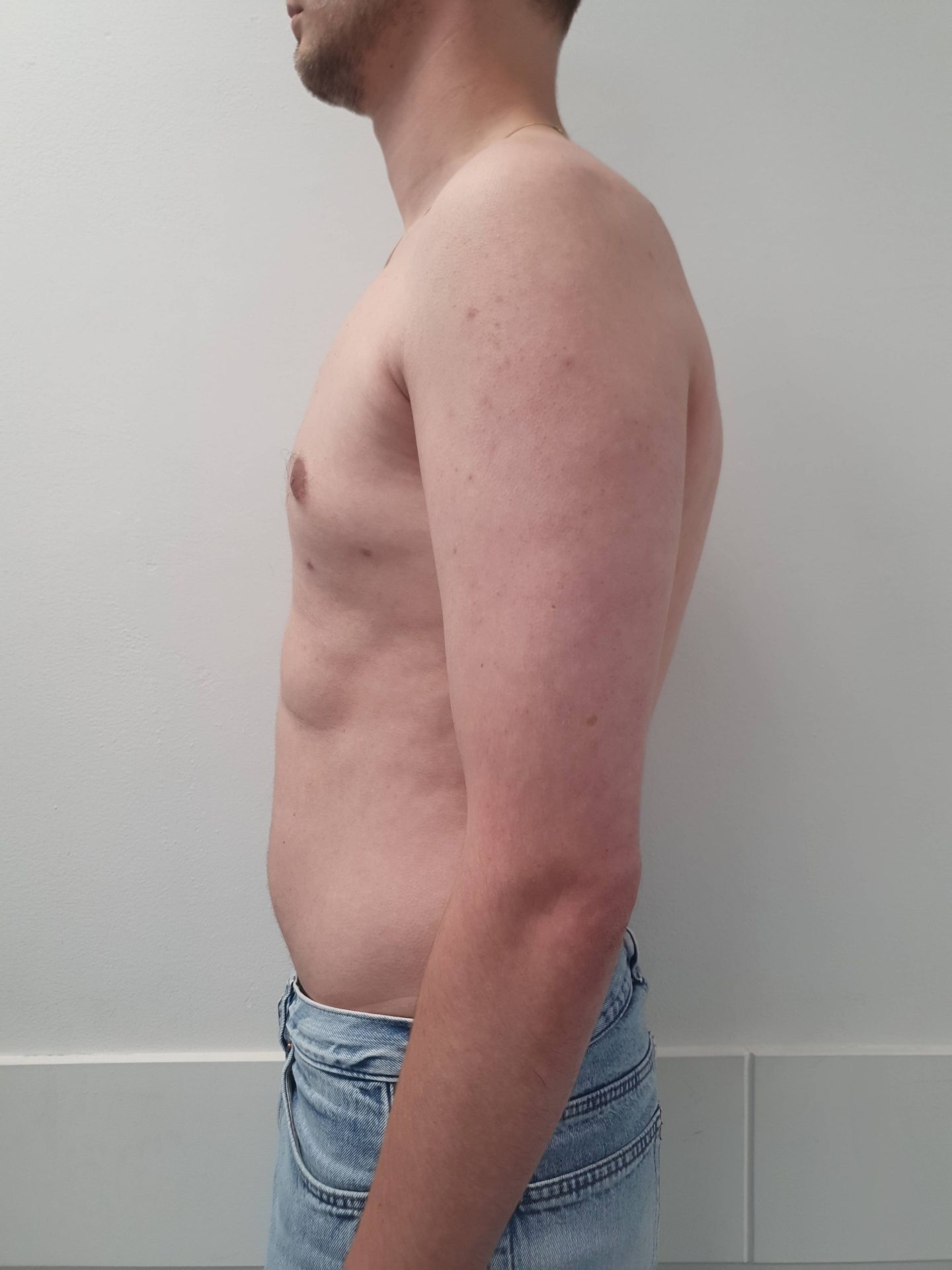 Breast correction for men after