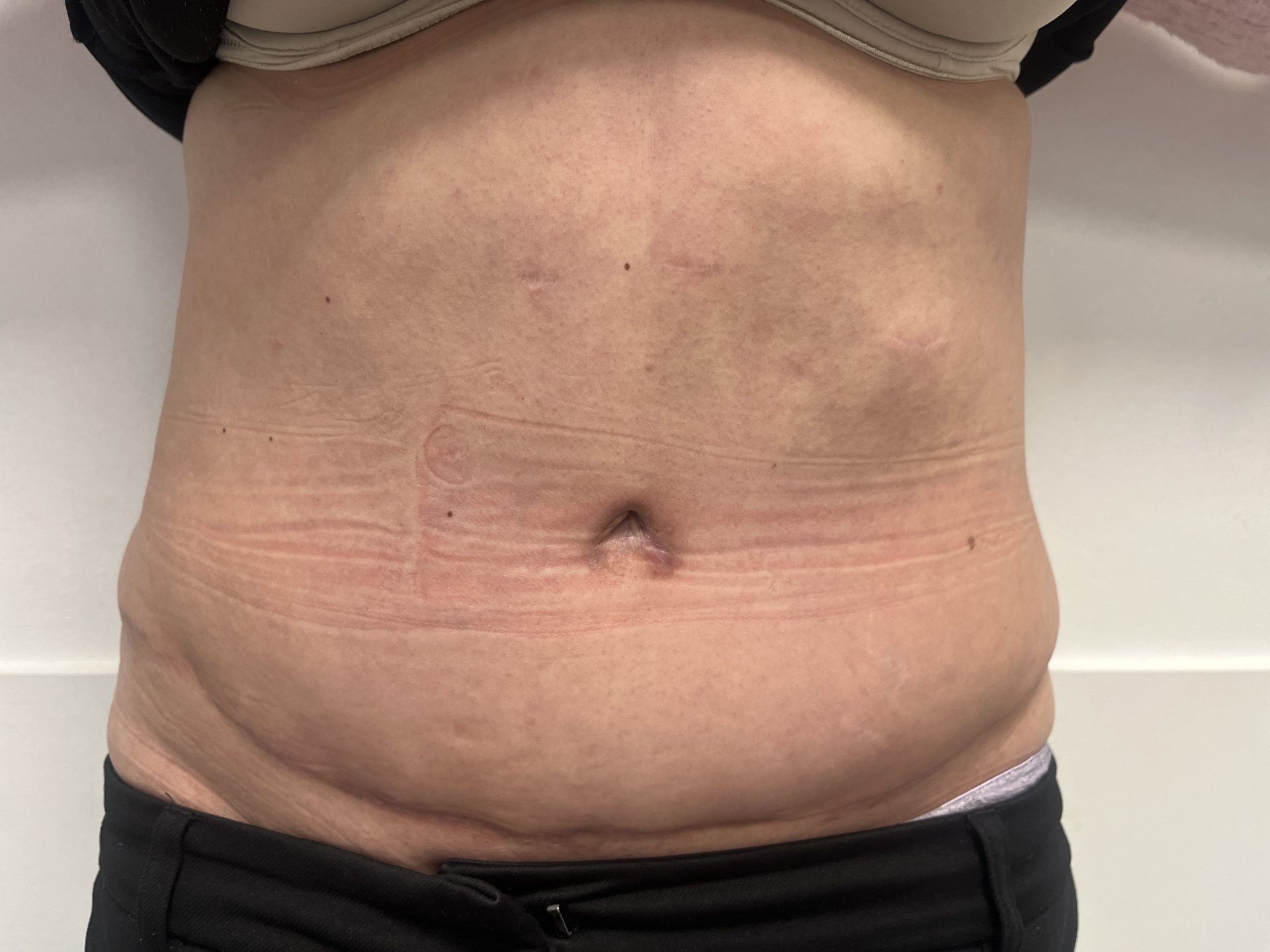 Tummy tuck after