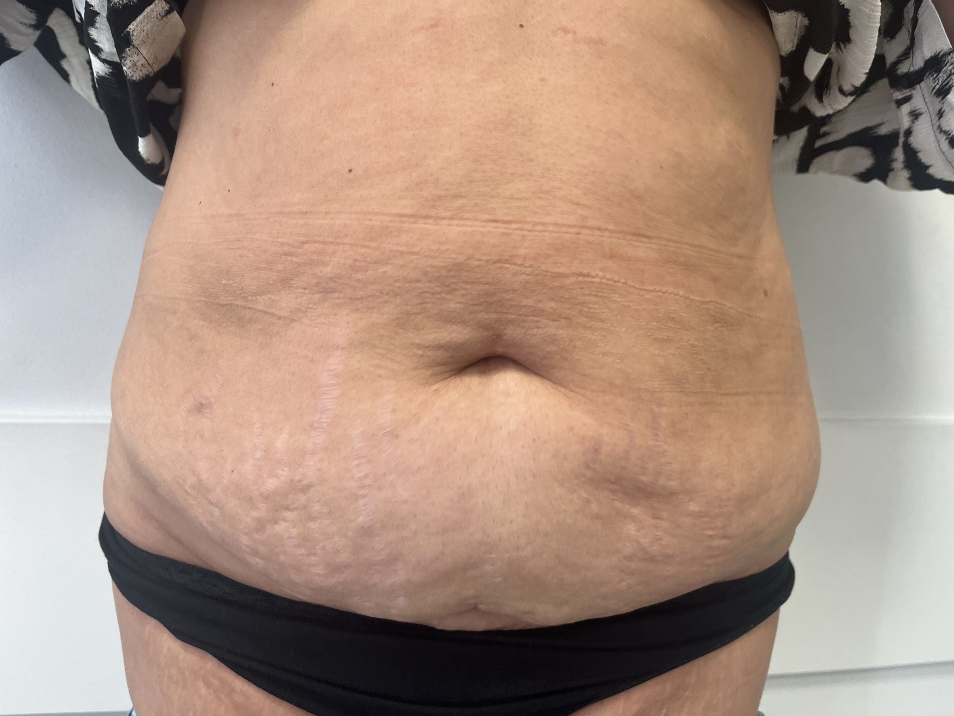 Tummy tuck before