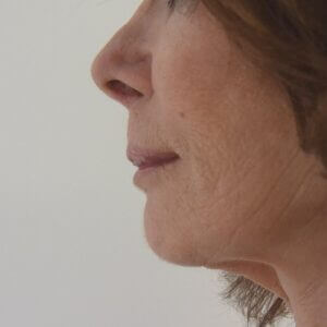 Lip correction before