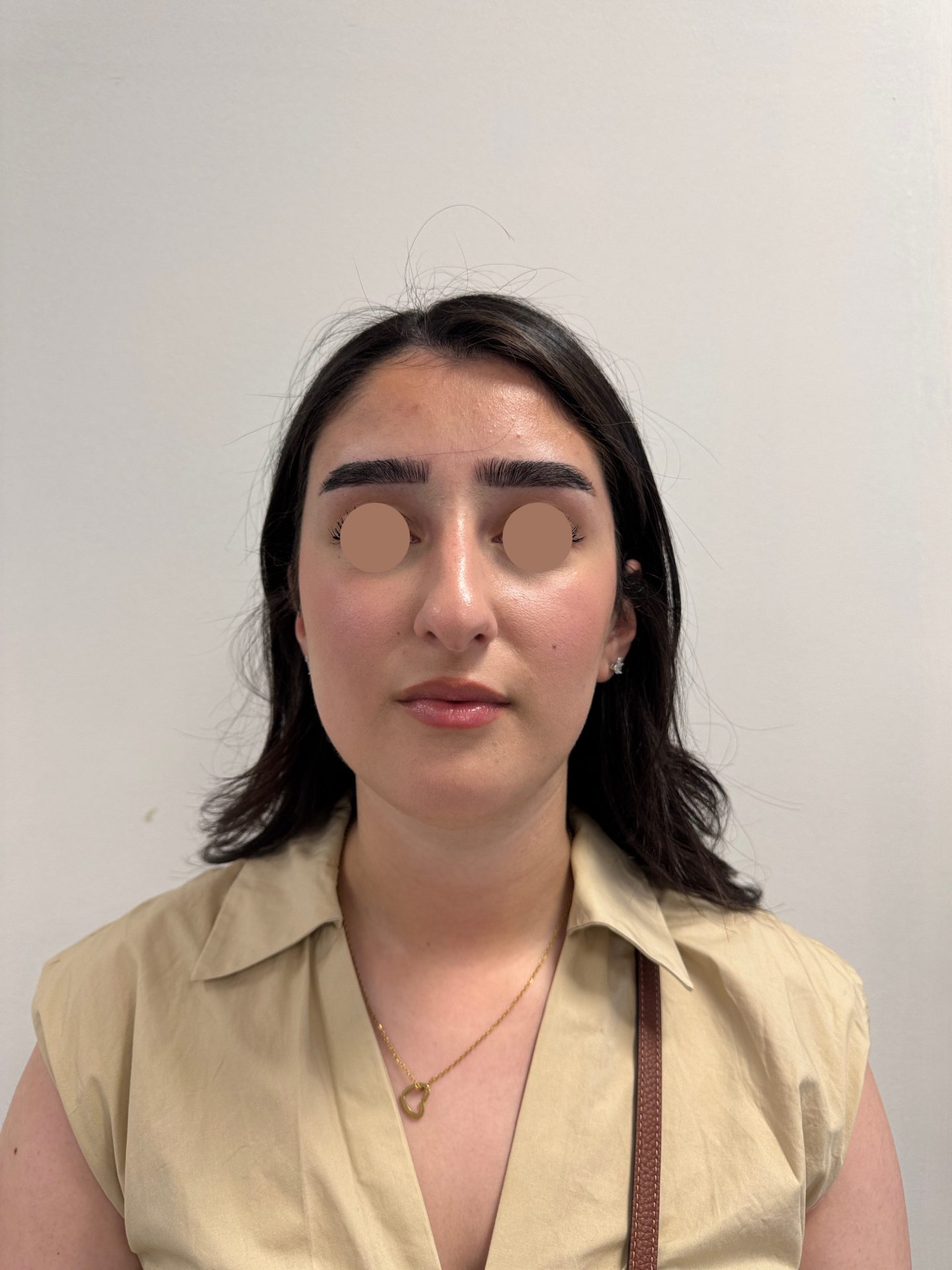 Nose correction before