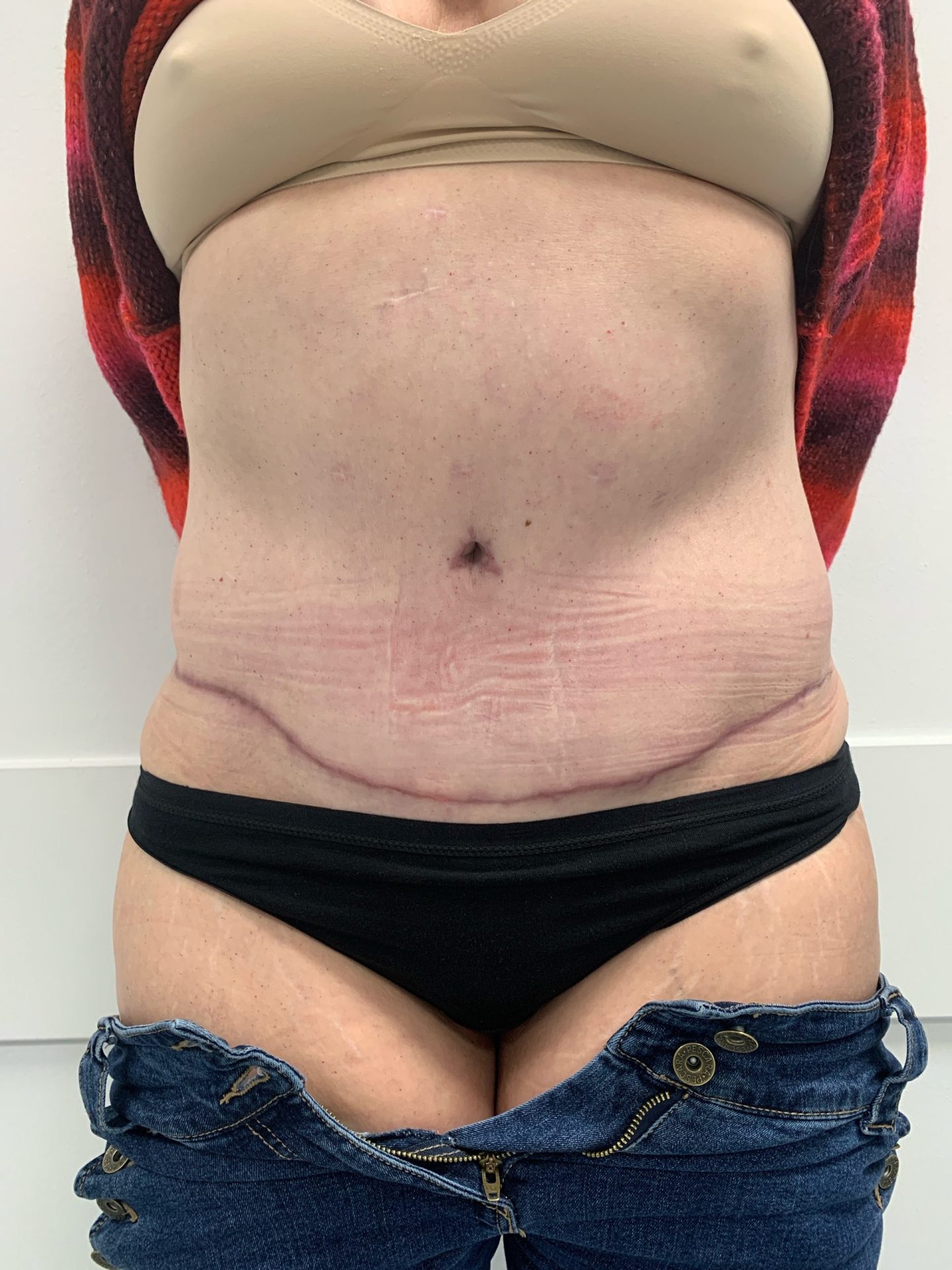Tummy tuck after