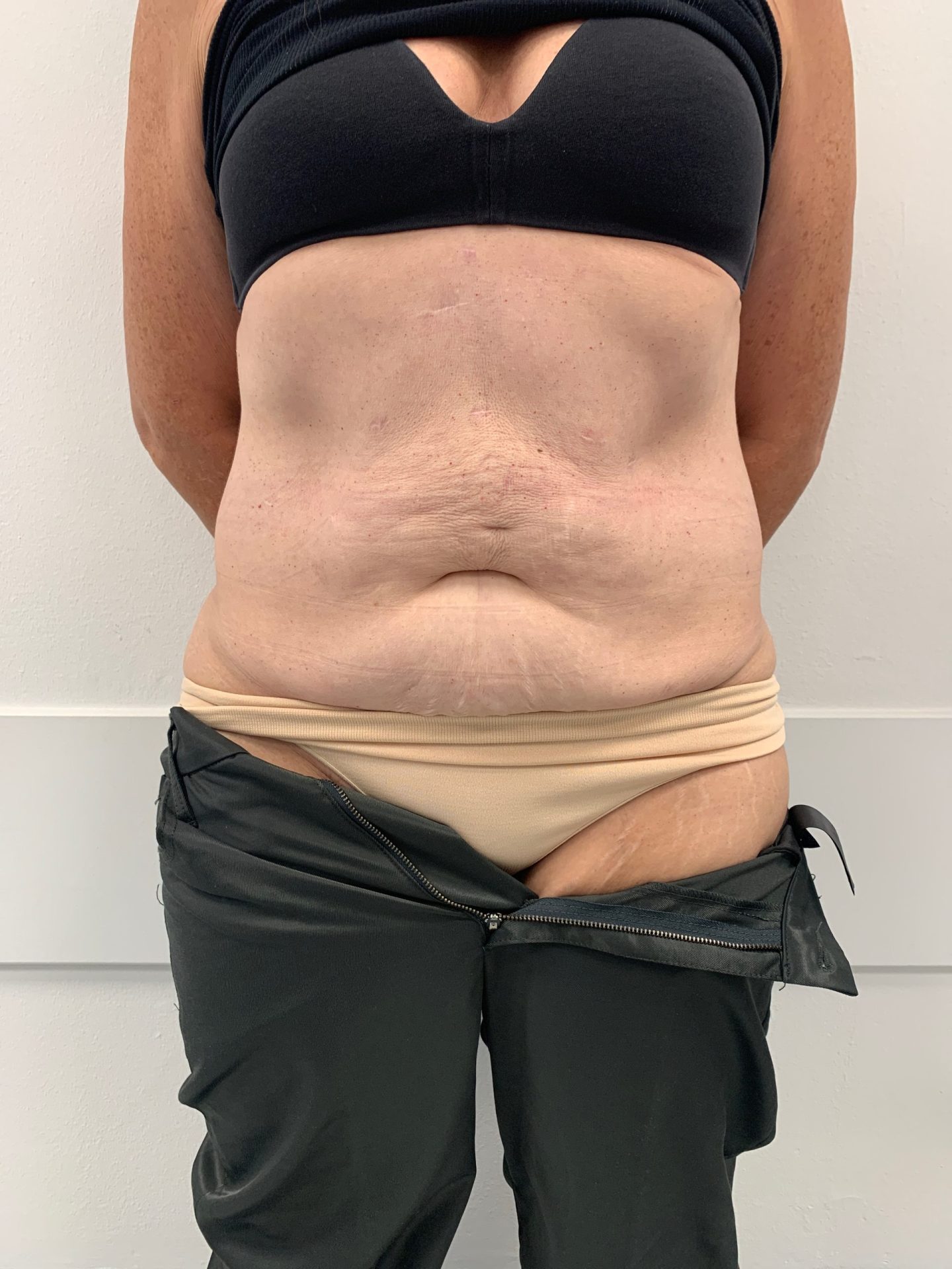 Tummy tuck before
