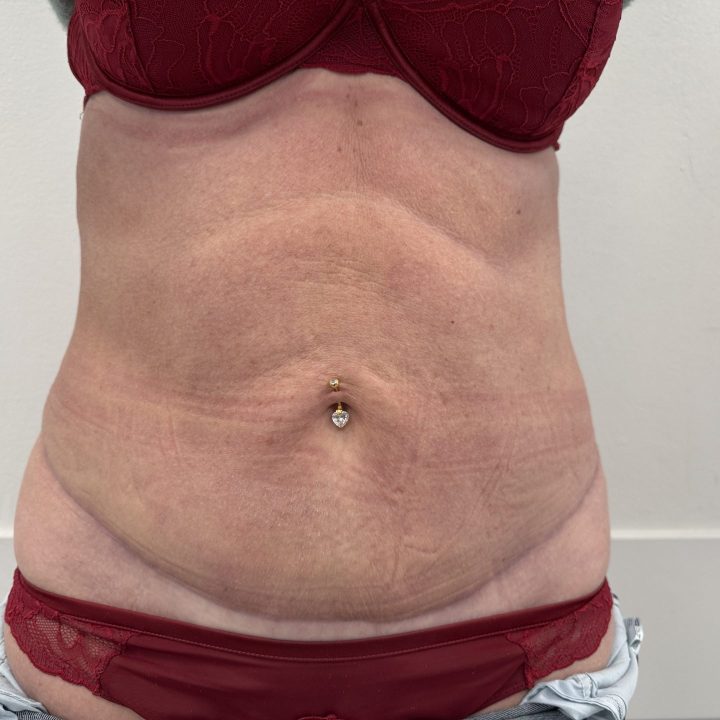 Tummy tuck after