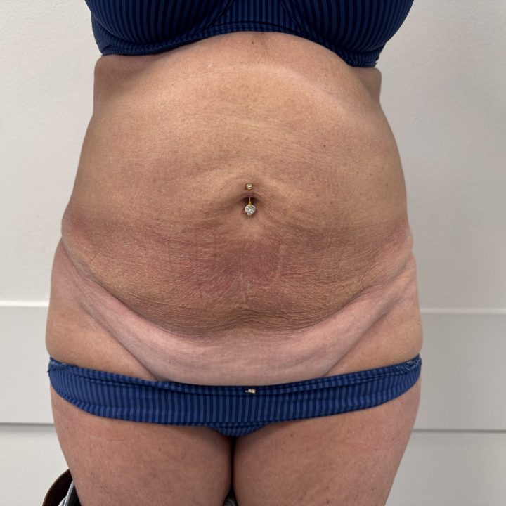 Tummy tuck before