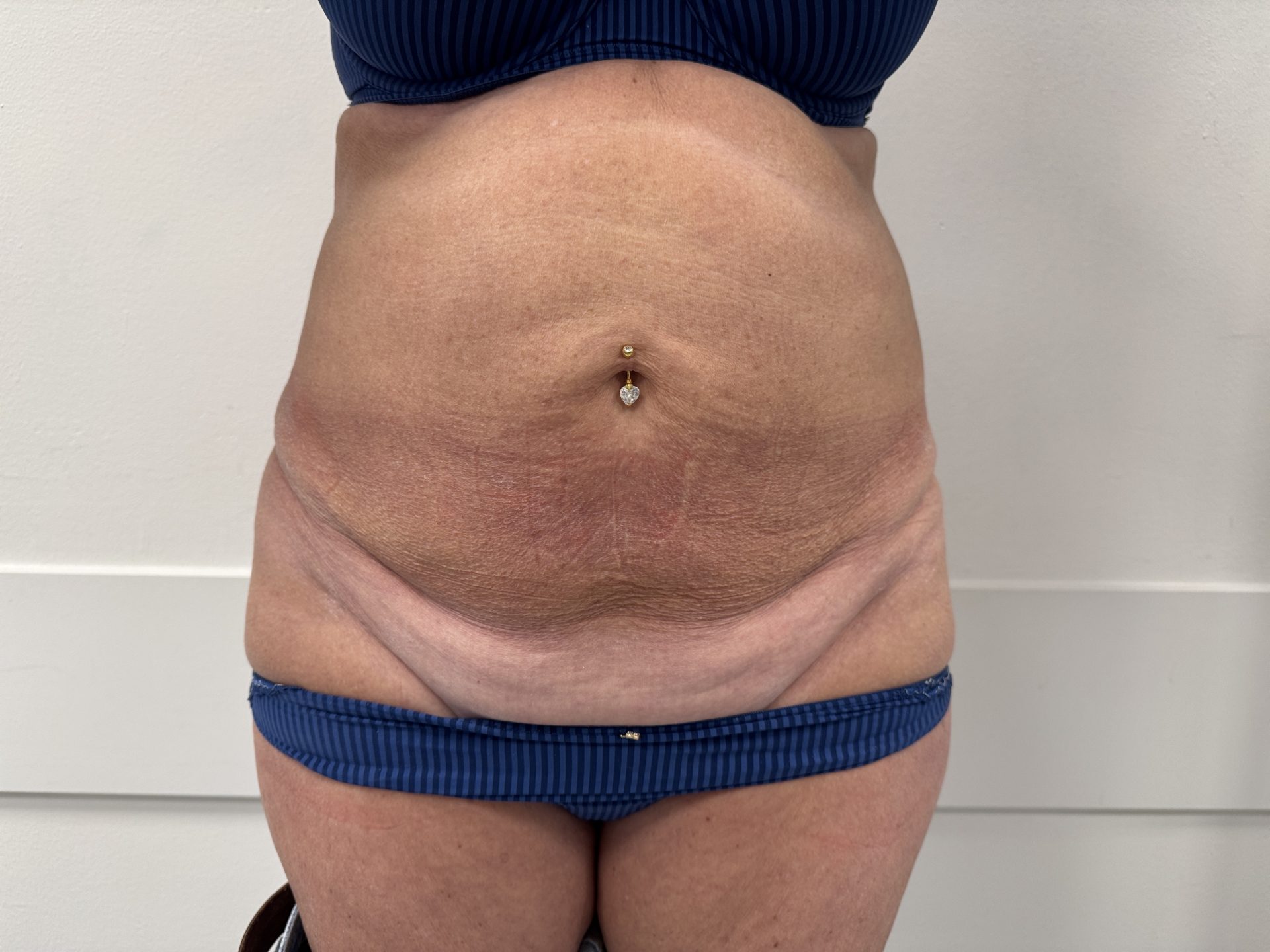 Liposuction before