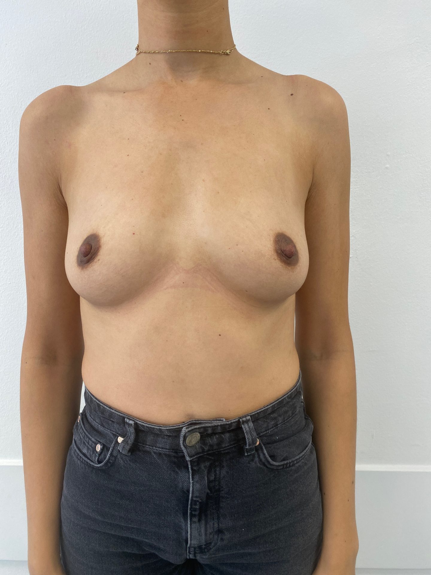 Breast augmentation before