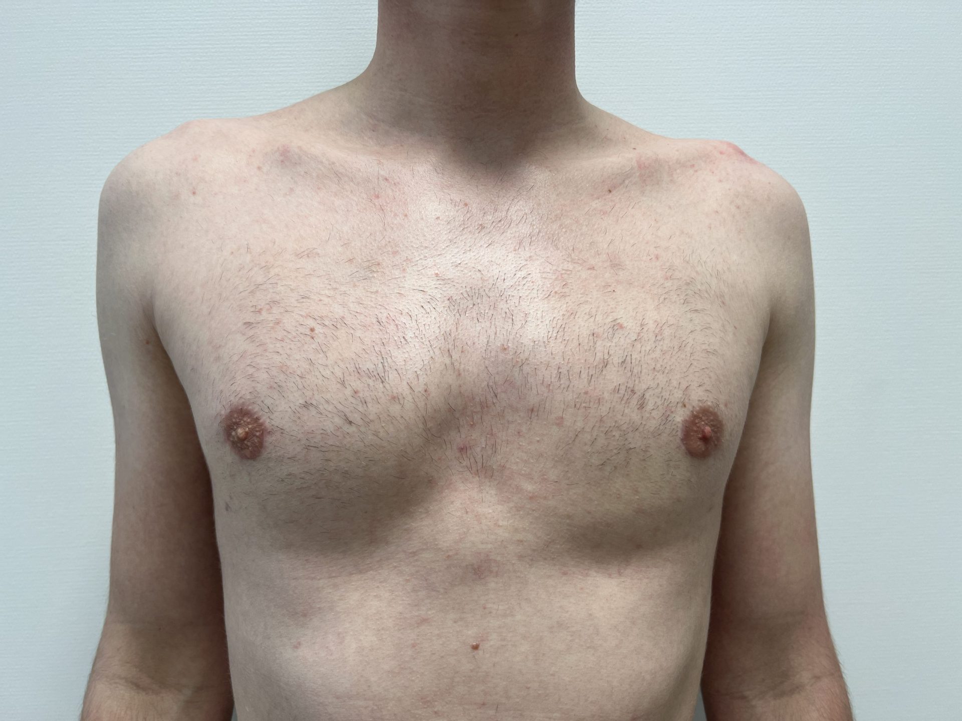 Breast correction for men after