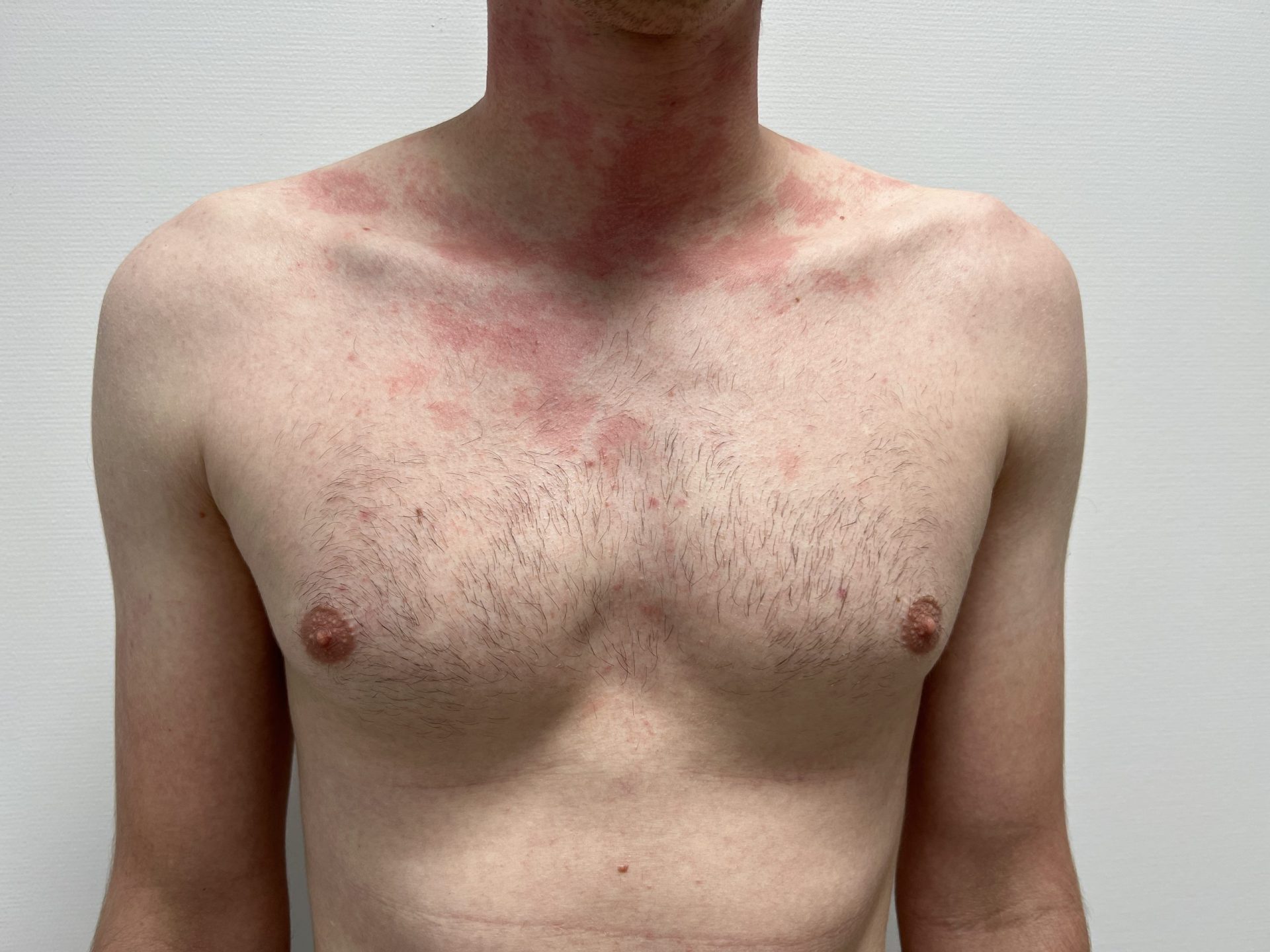 Breast correction for men before
