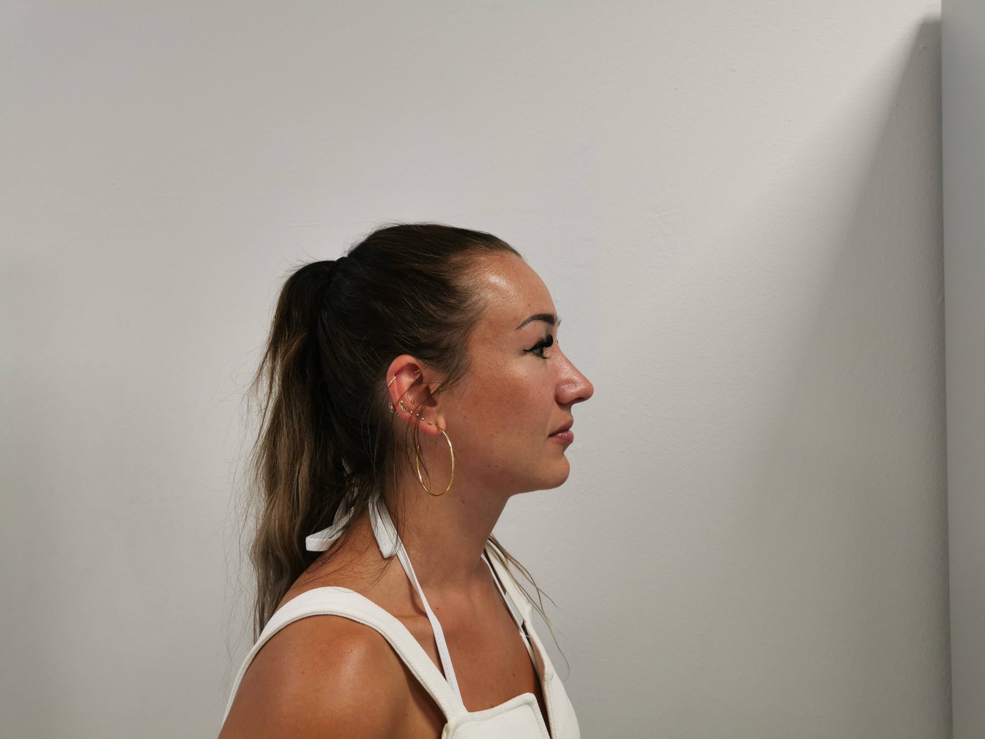 Nose correction after