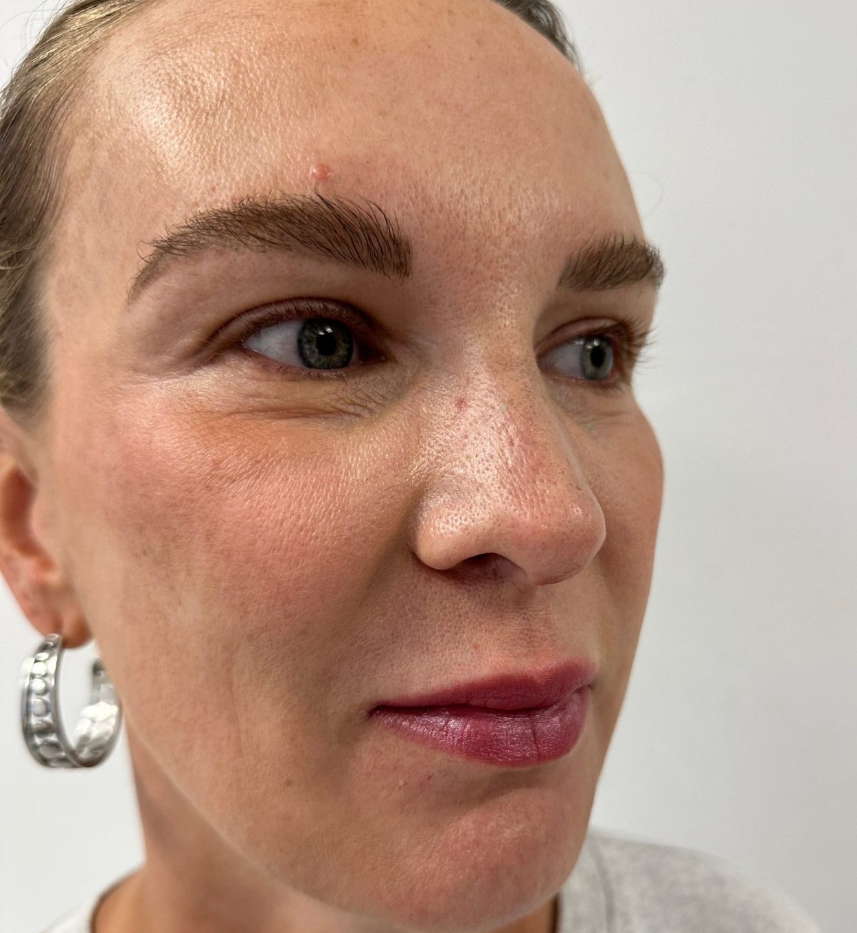Eyelid correction after