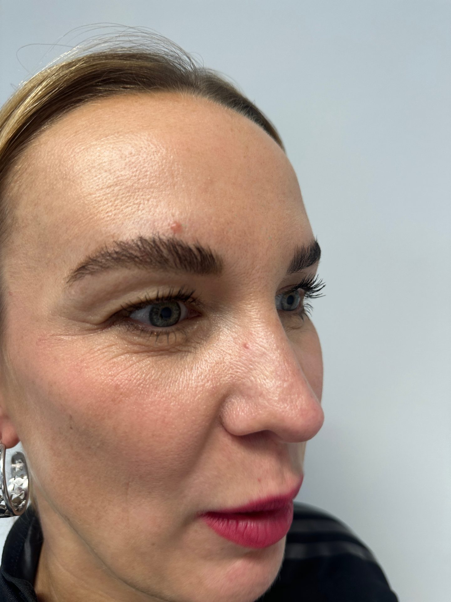 Eyelid correction before