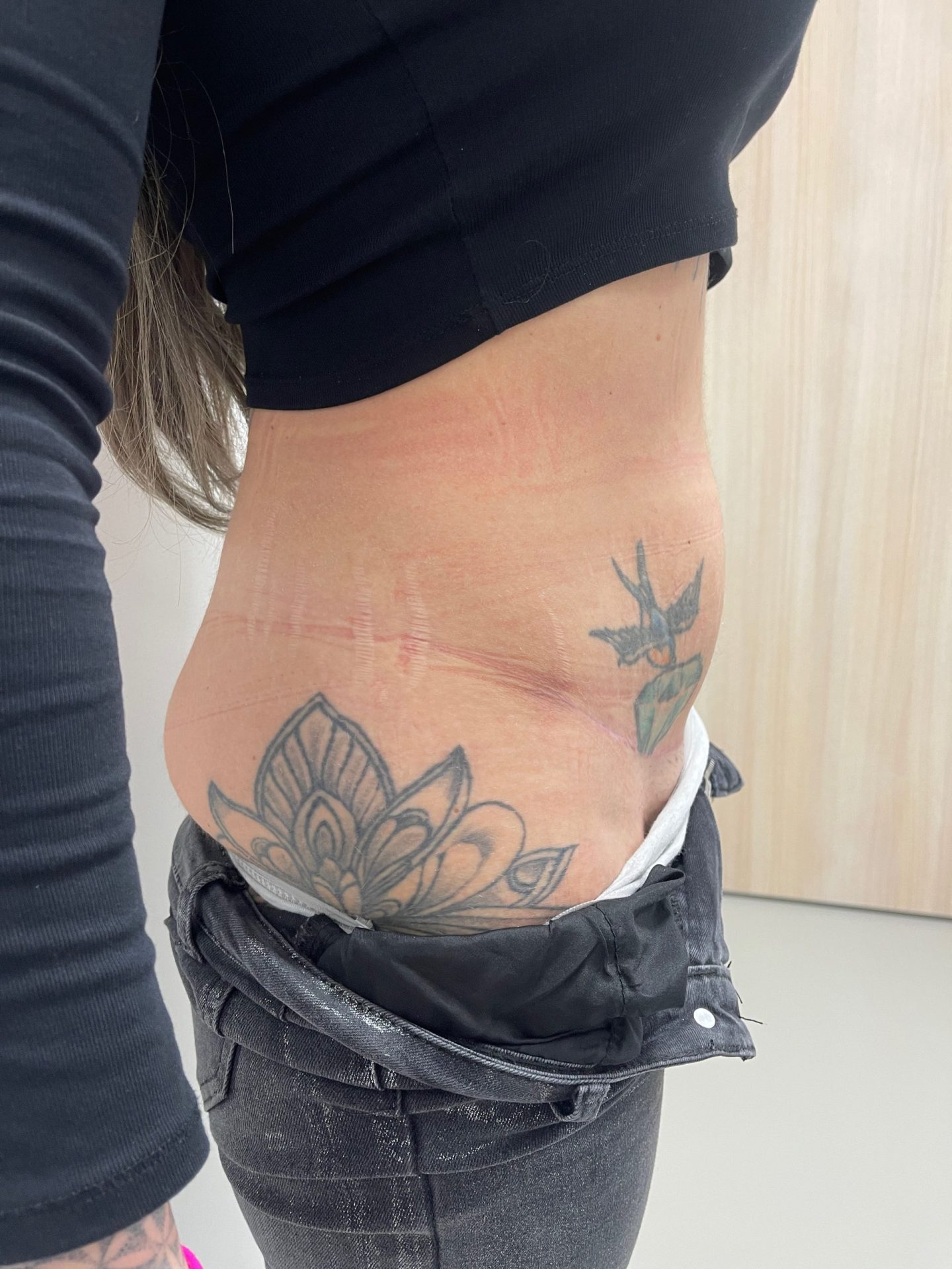 Tummy tuck after