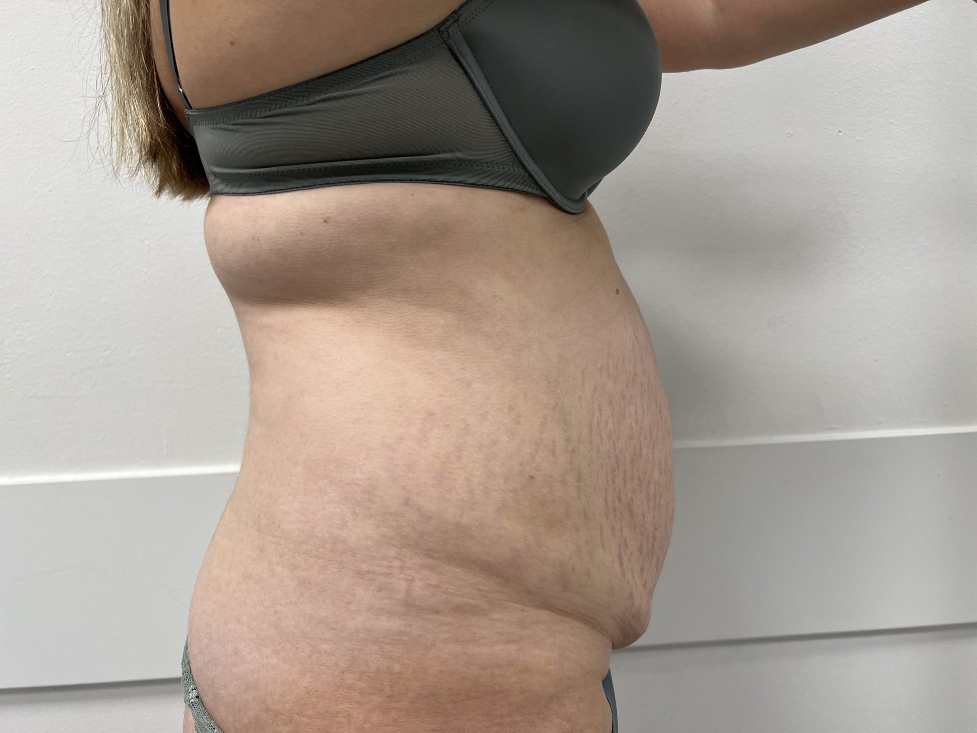 Tummy tuck before