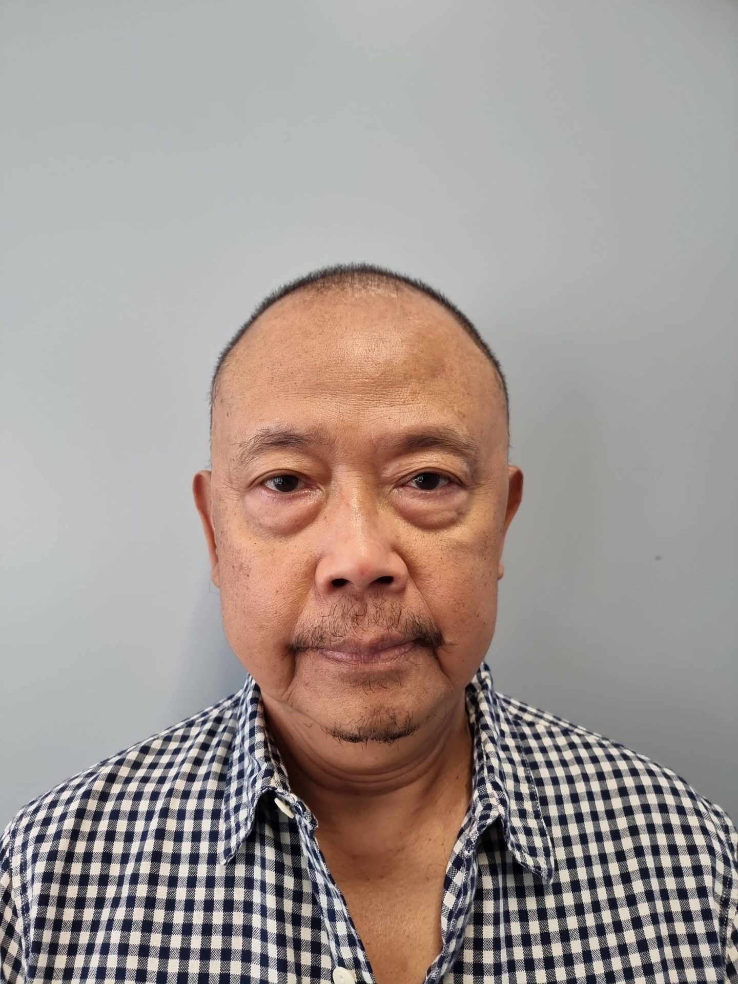 Eyelid correction before