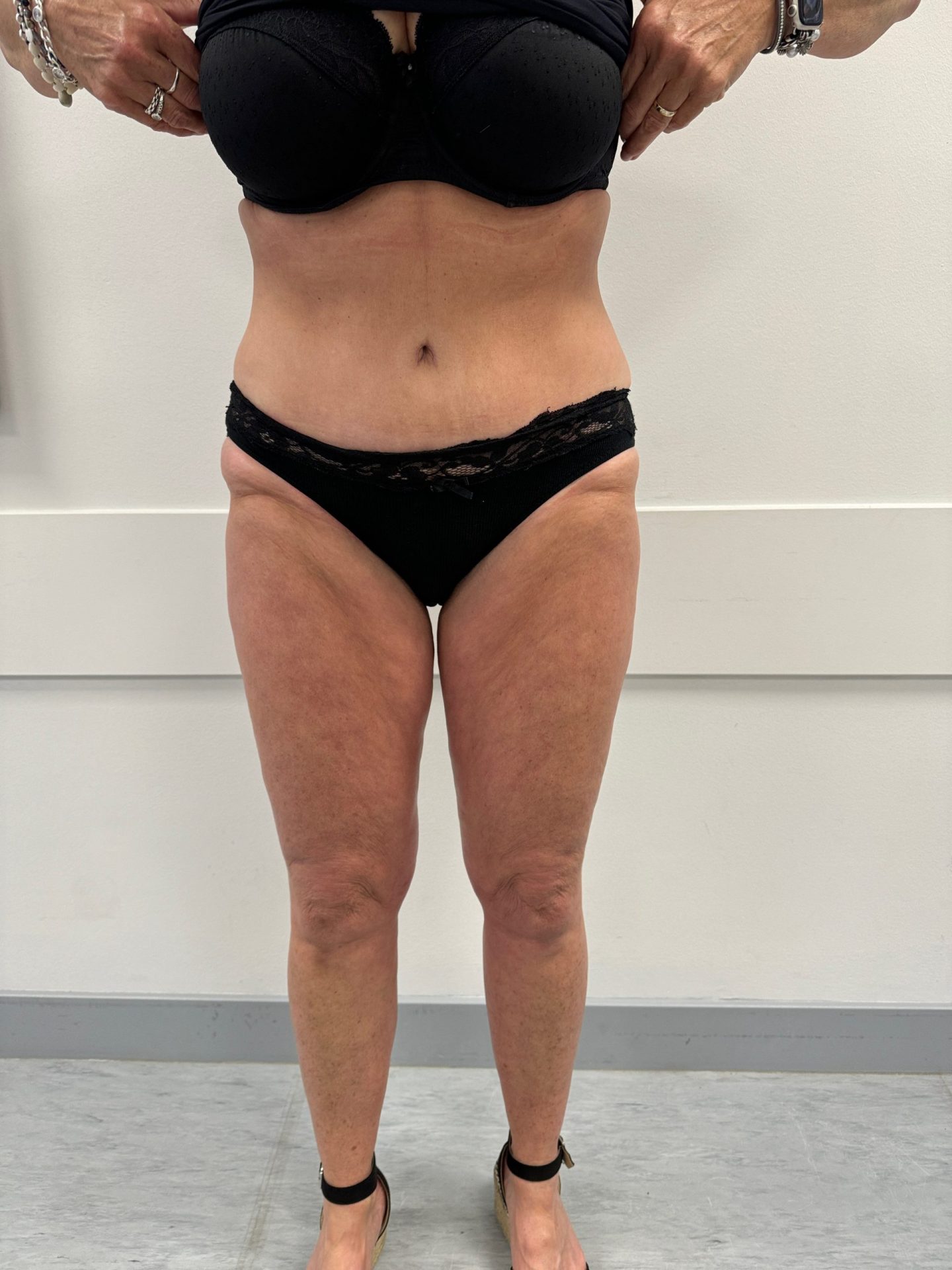 Tummy tuck after