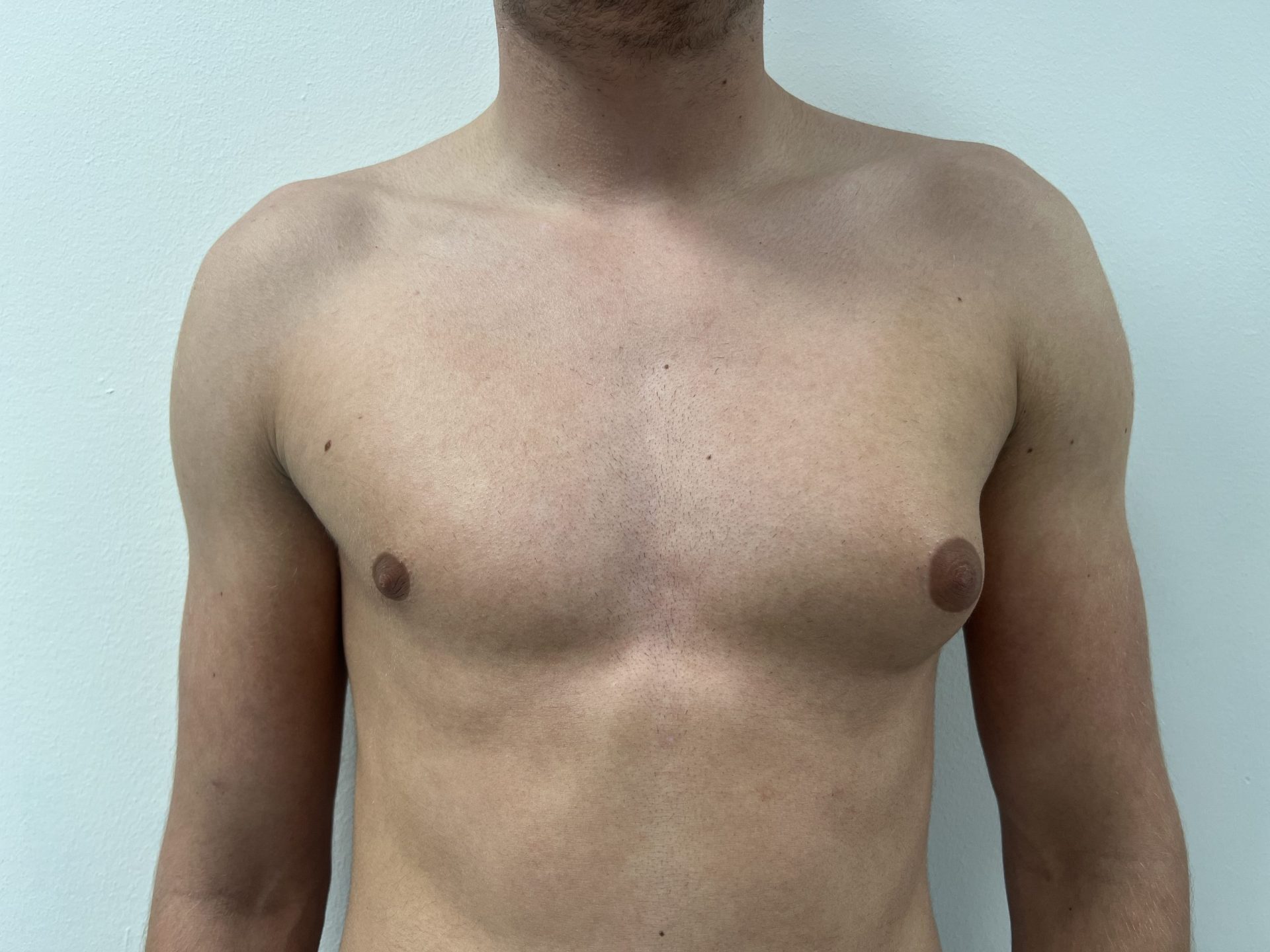Breast correction for men before
