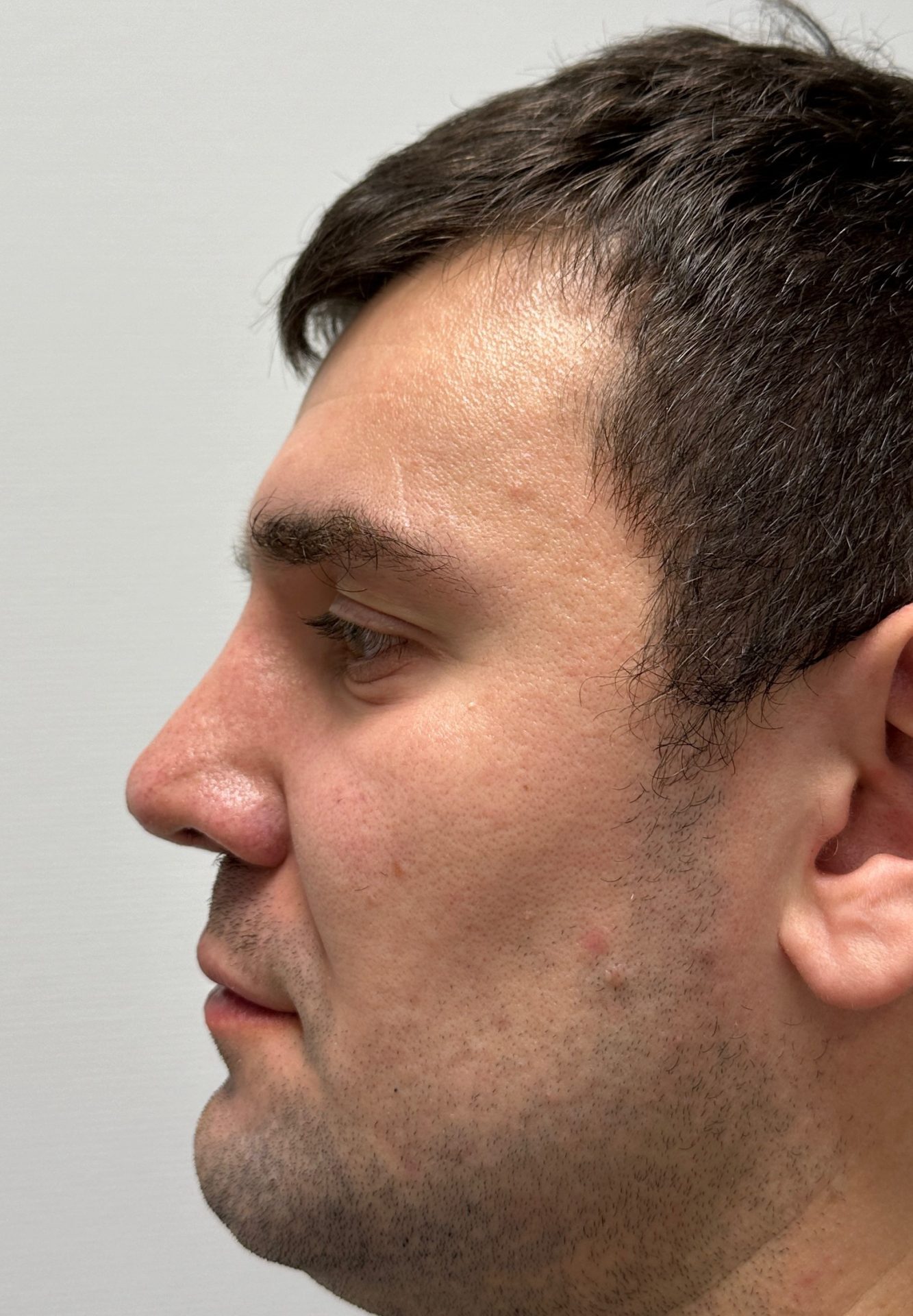 Nose correction after