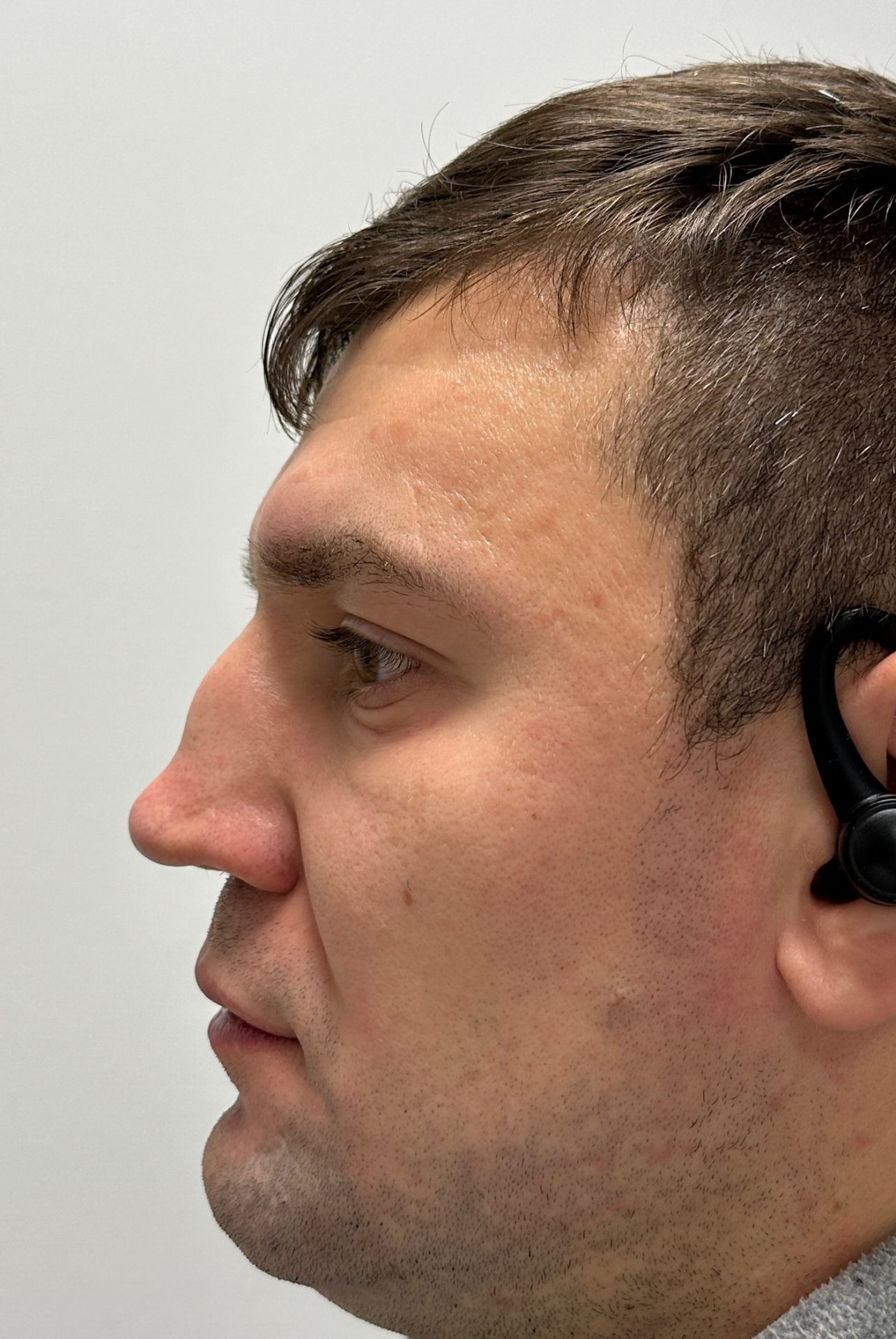 Nose correction before