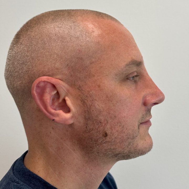 Nose correction after