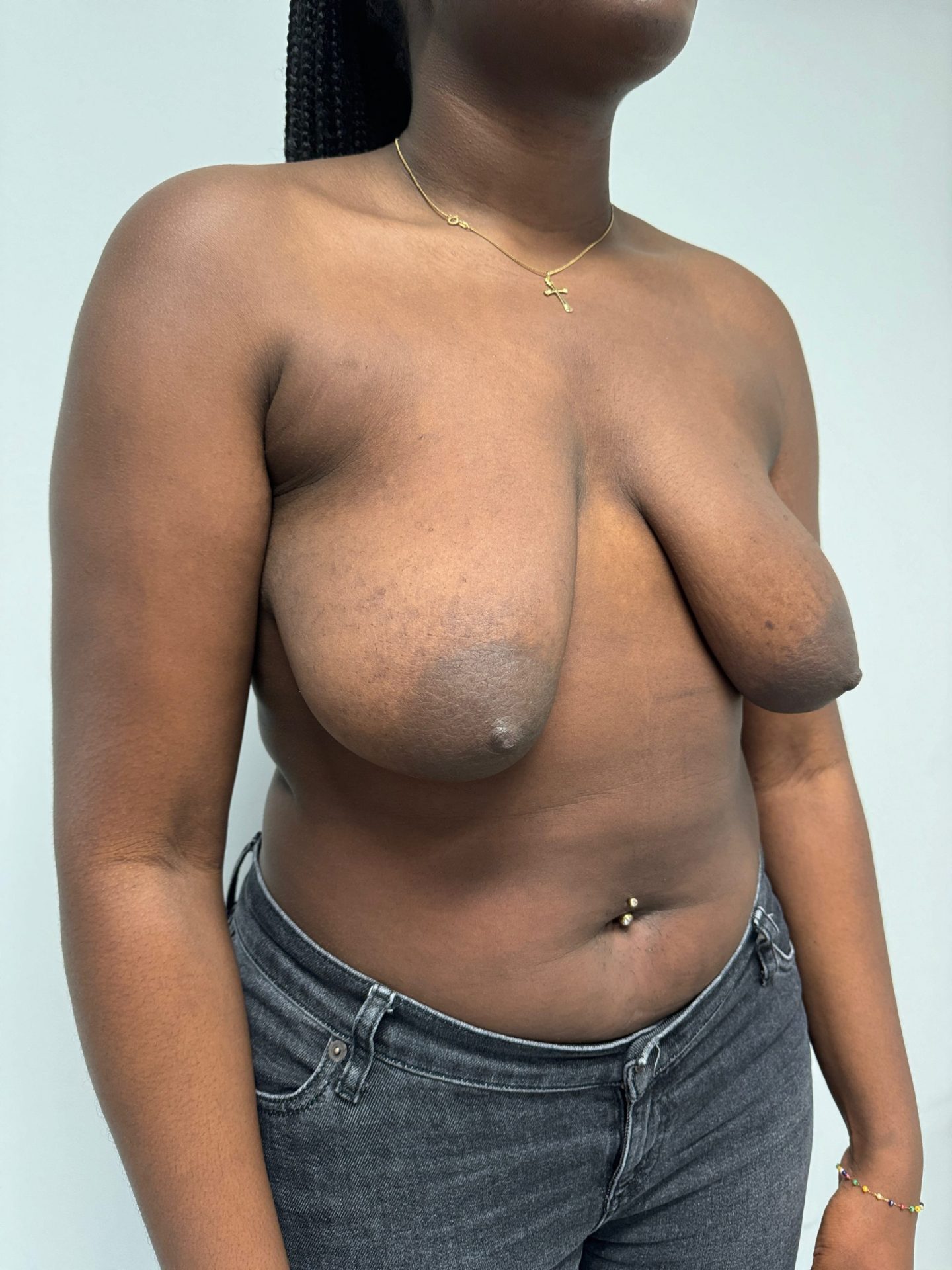 Breast lift before