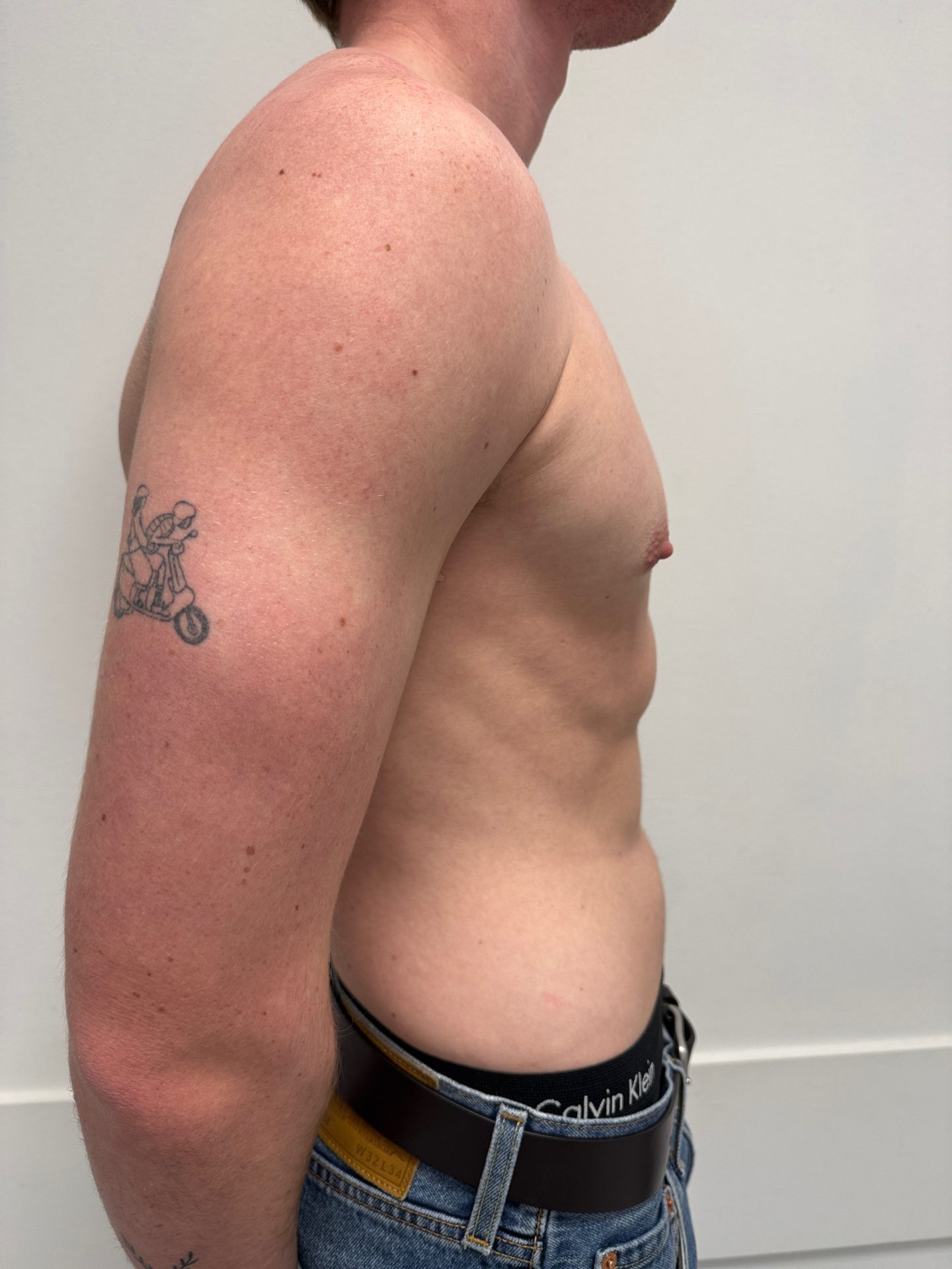 Breast correction for men after