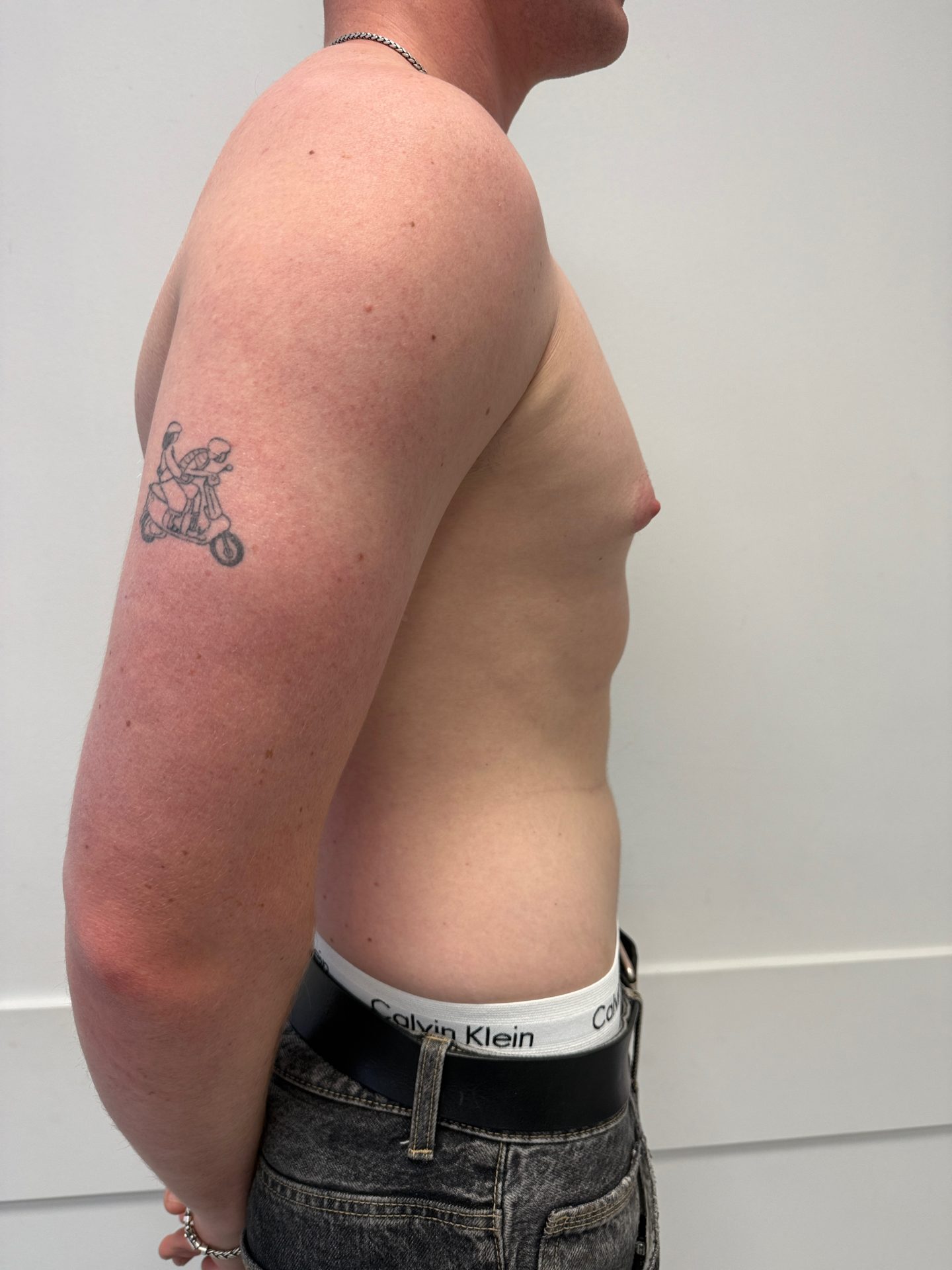 Breast correction for men before