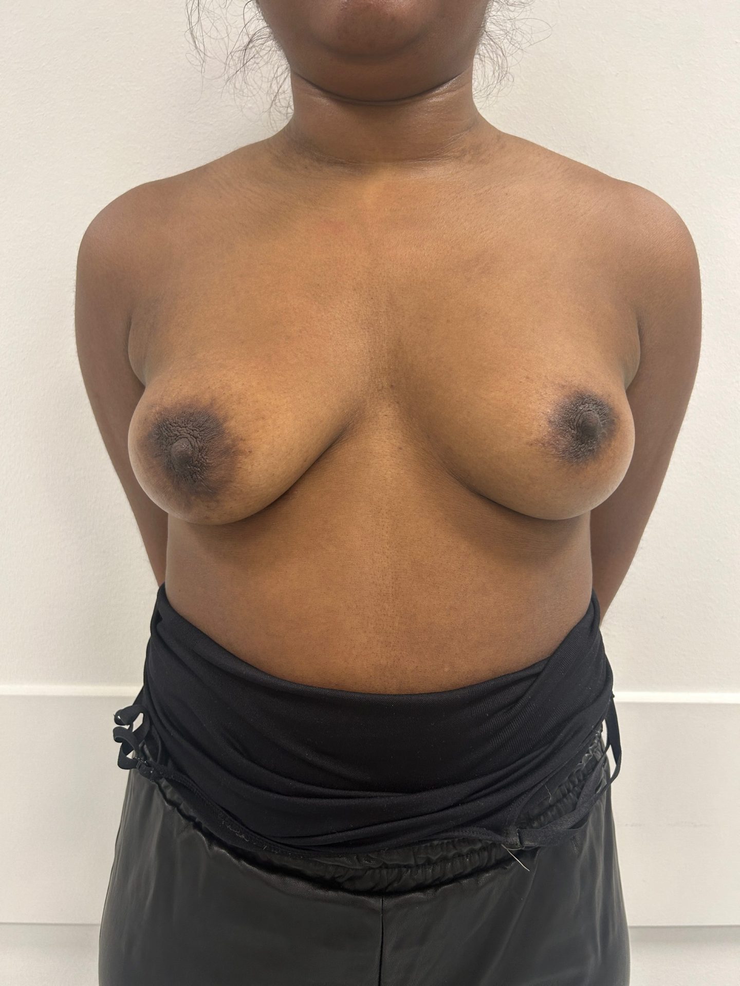 Breast augmentation before
