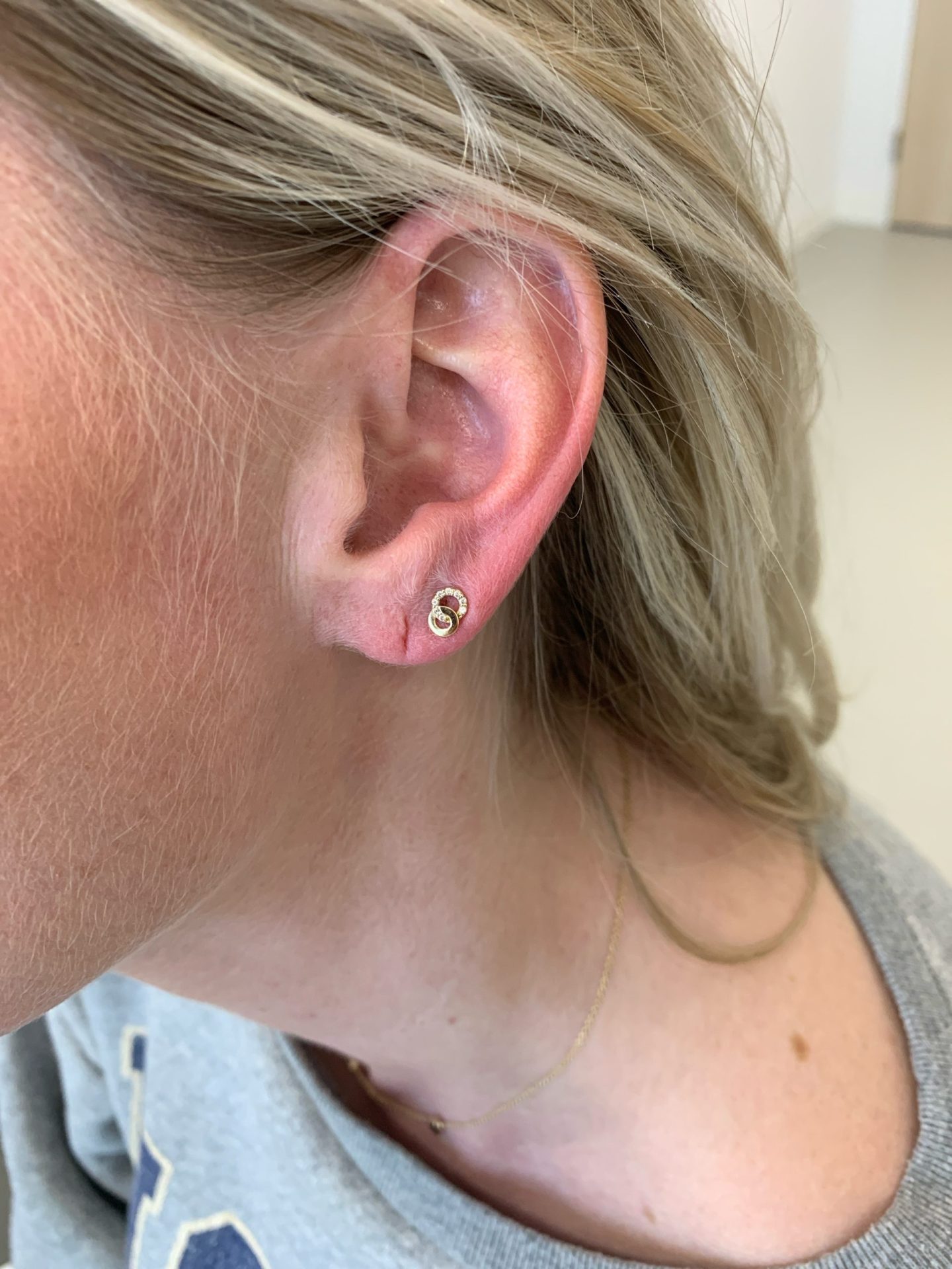 Earlobe correction before
