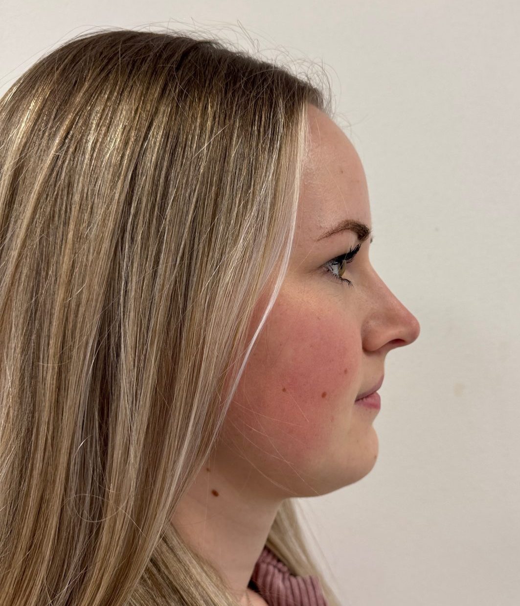 Nose correction after