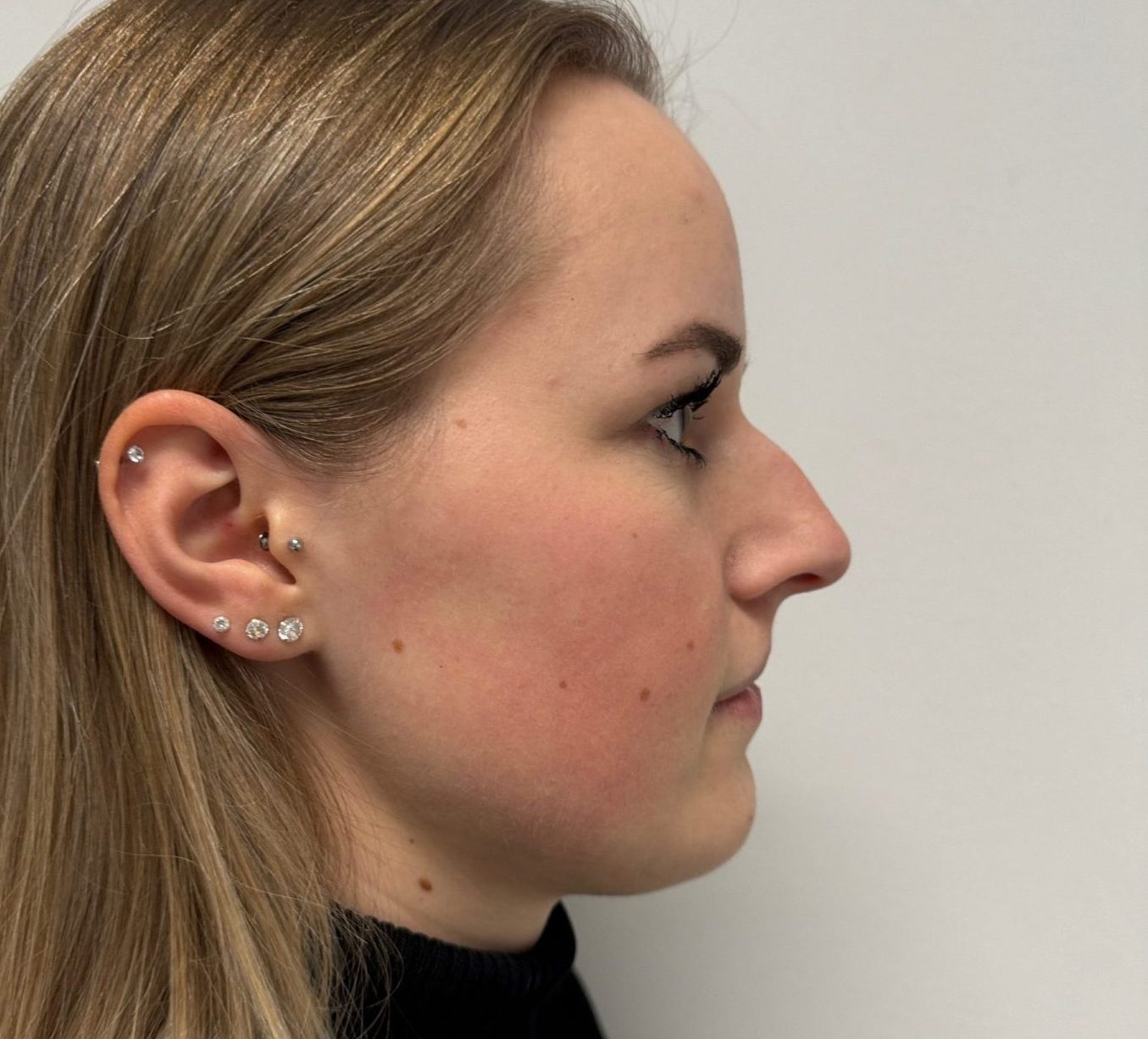 Nose correction before