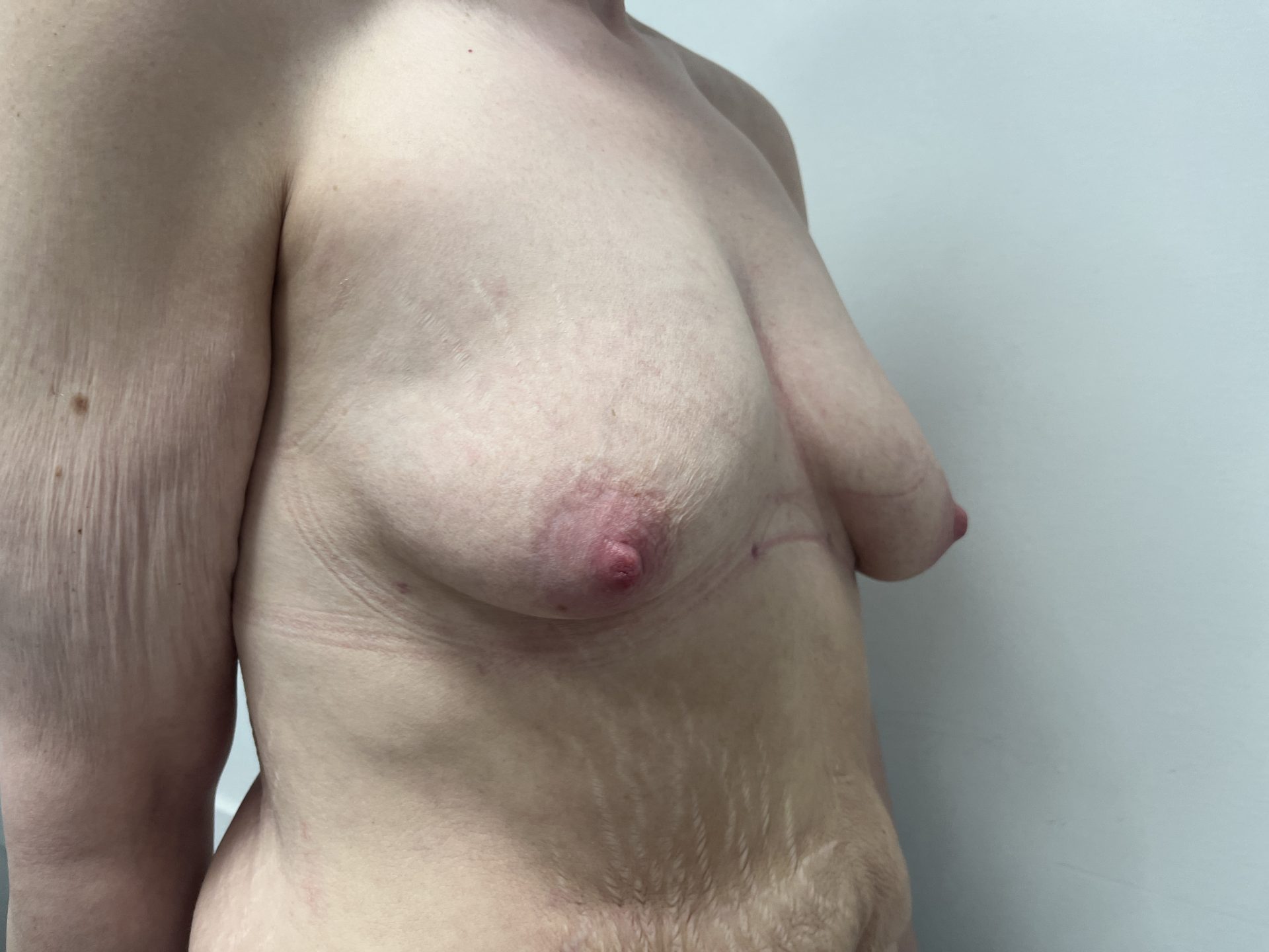 Breast augmentation before