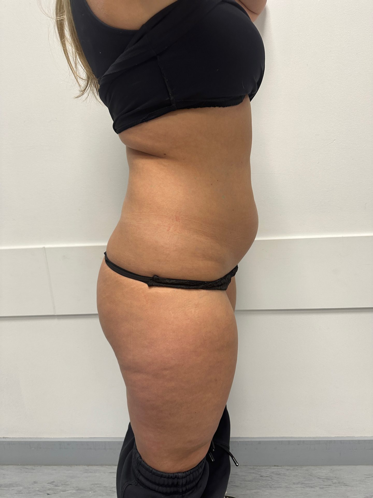 Liposuction before
