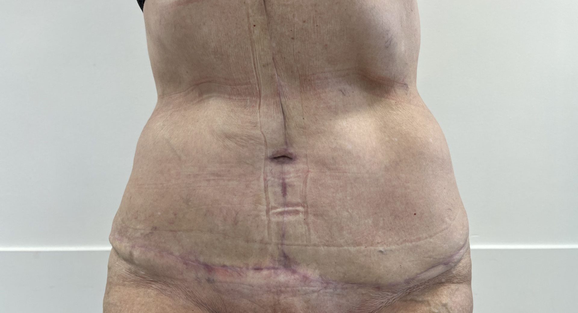 Tummy tuck after