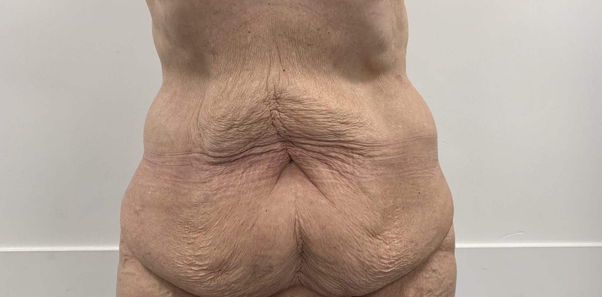 Tummy tuck before