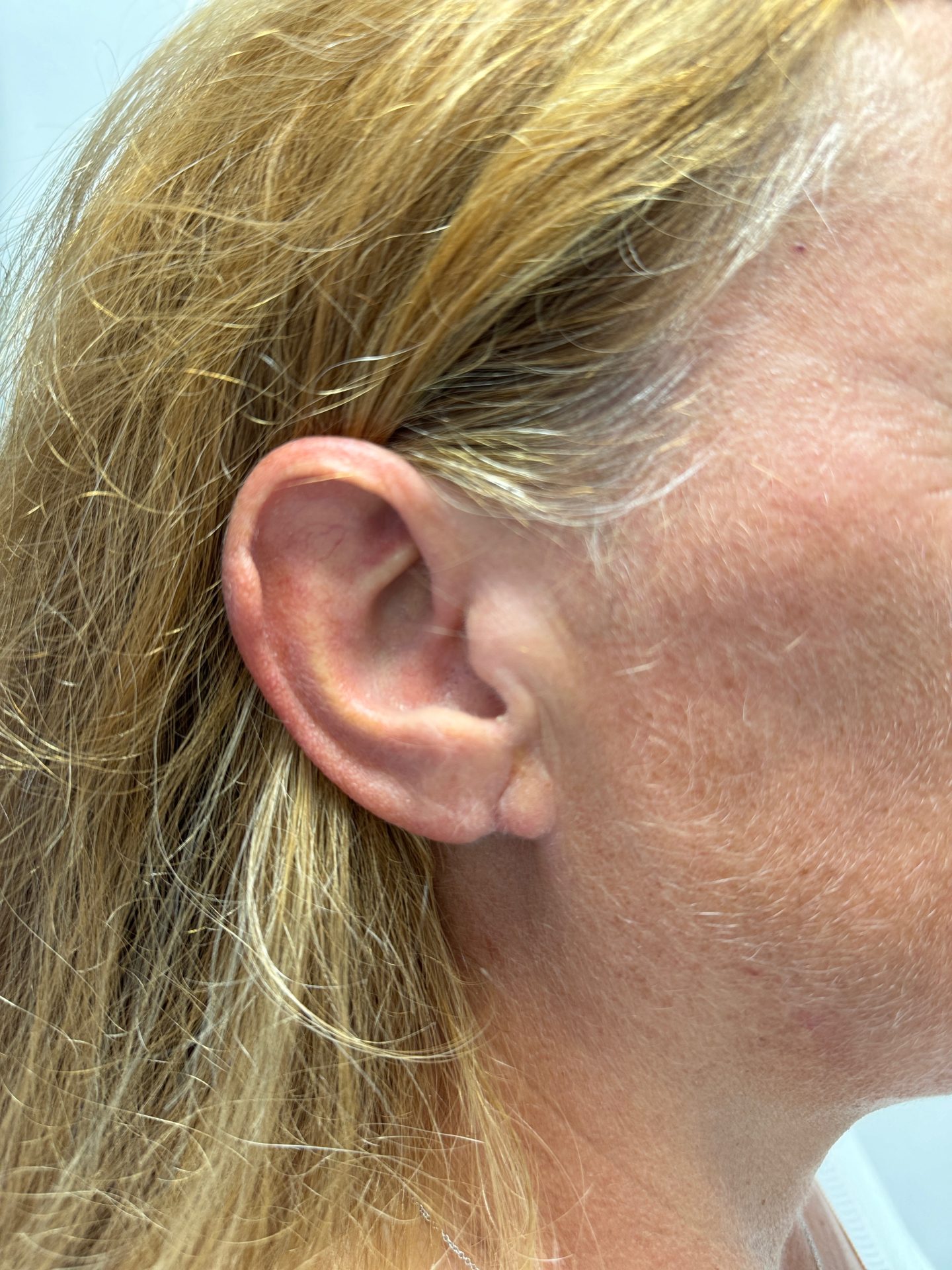 Earlobe correction after