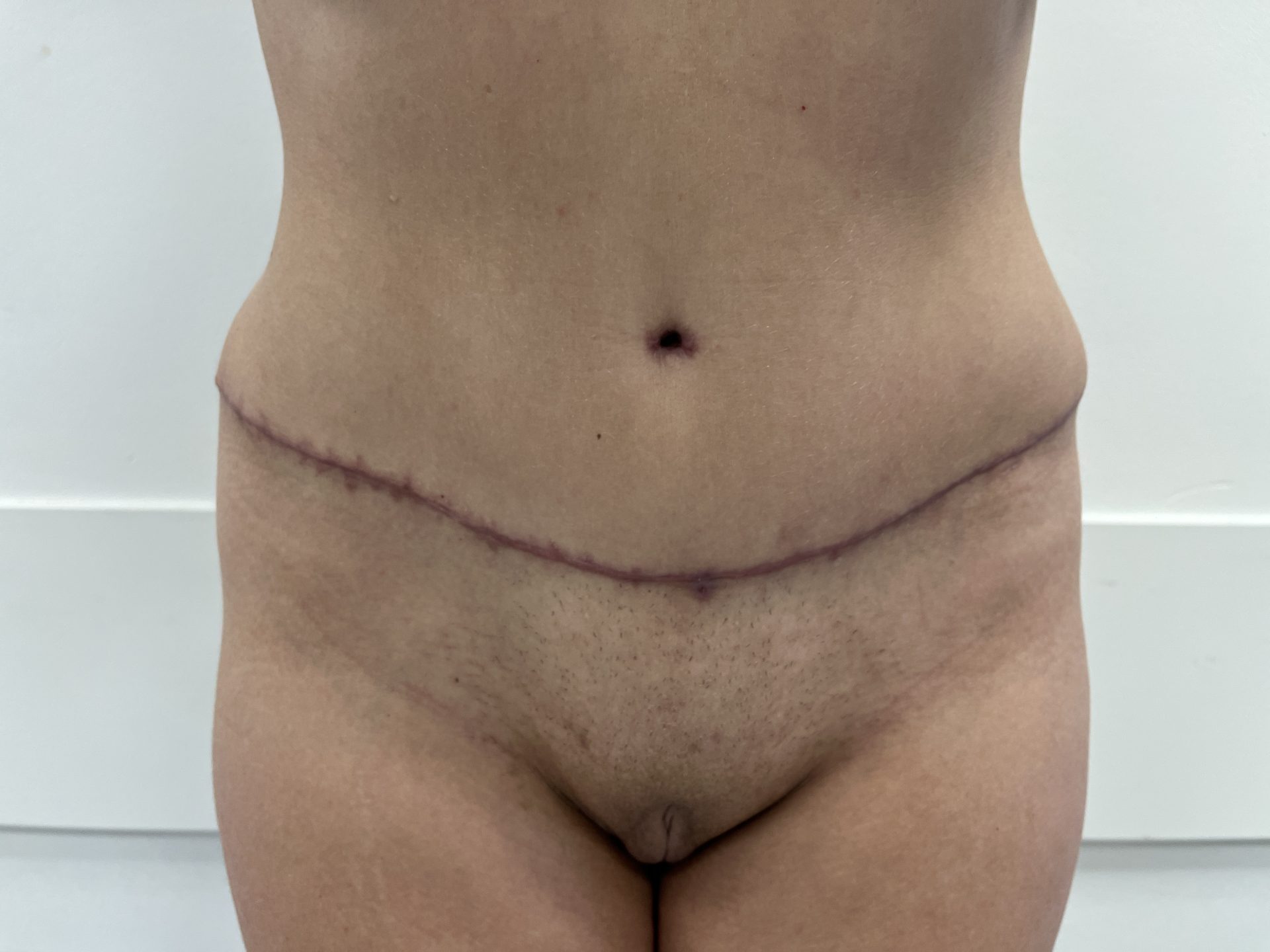 Tummy tuck after