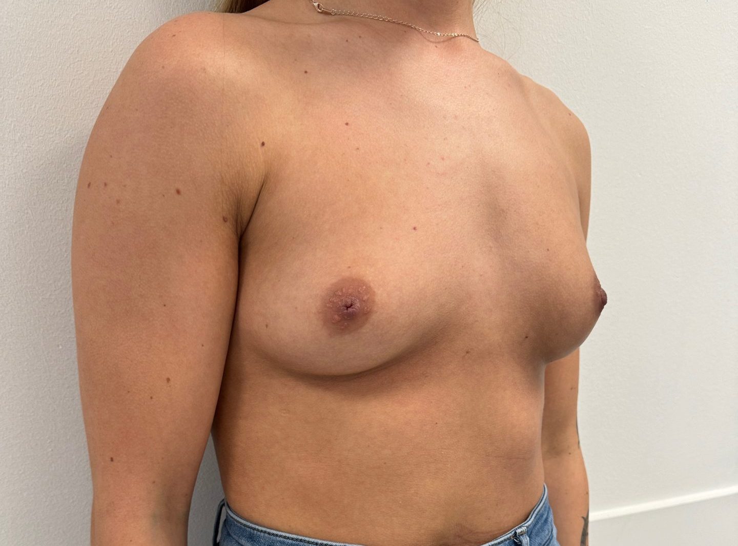 Breast augmentation before