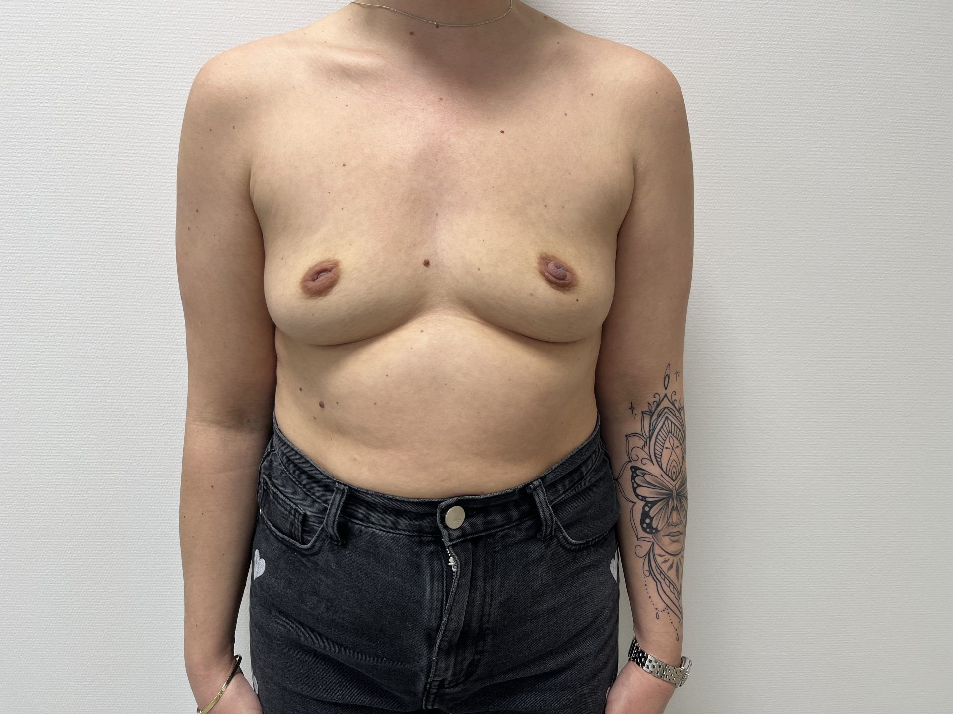 Breast augmentation before