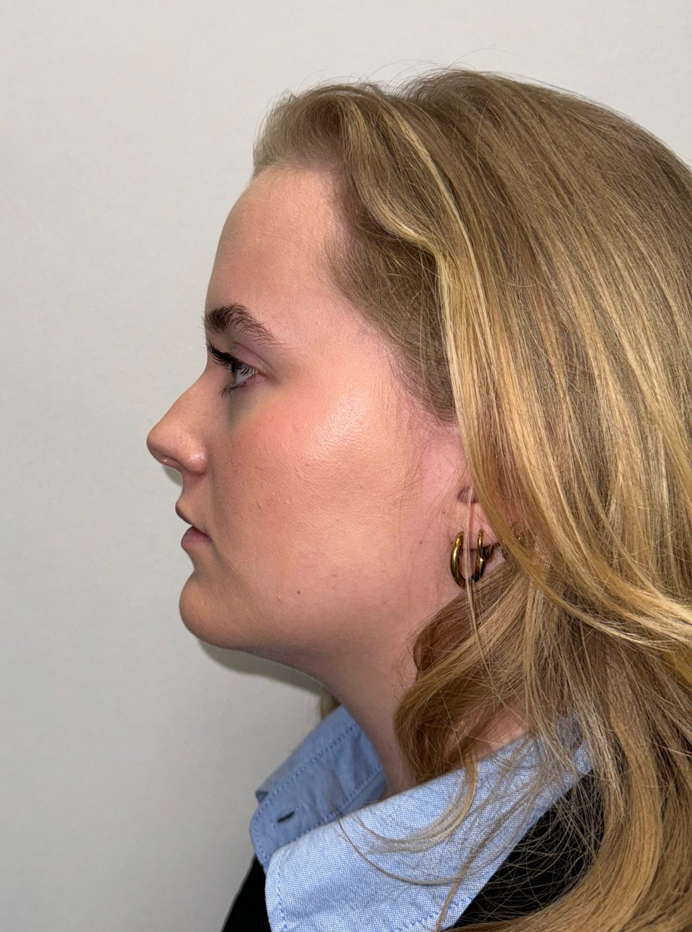Nose correction before