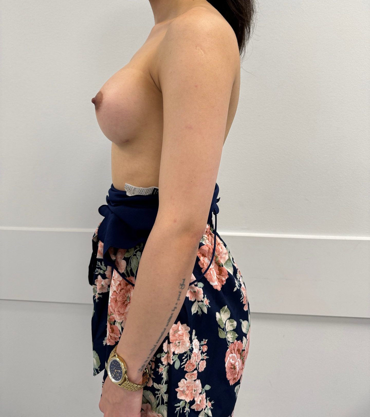 Breast augmentation after