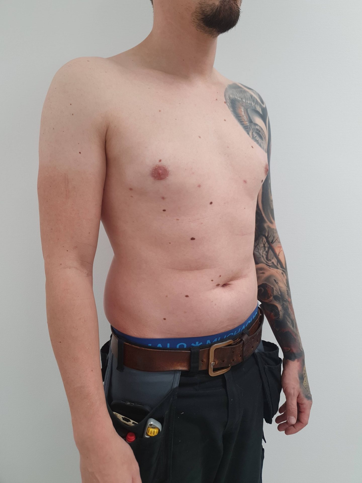 Breast correction for men after