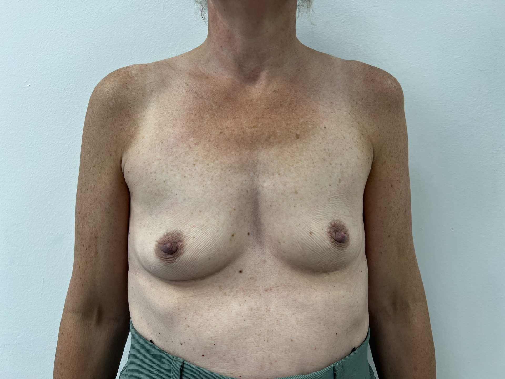Breast augmentation before