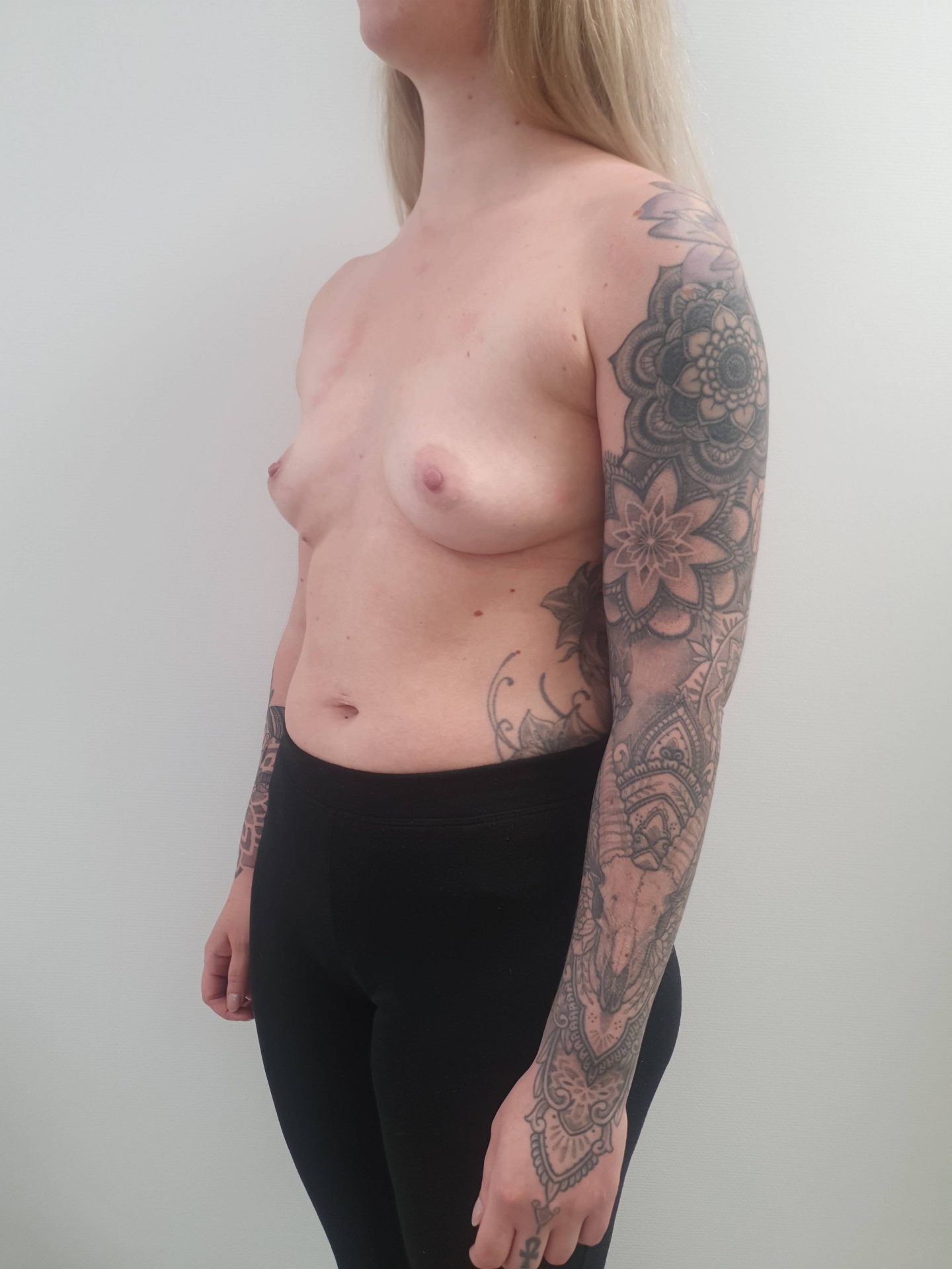 Breast augmentation before
