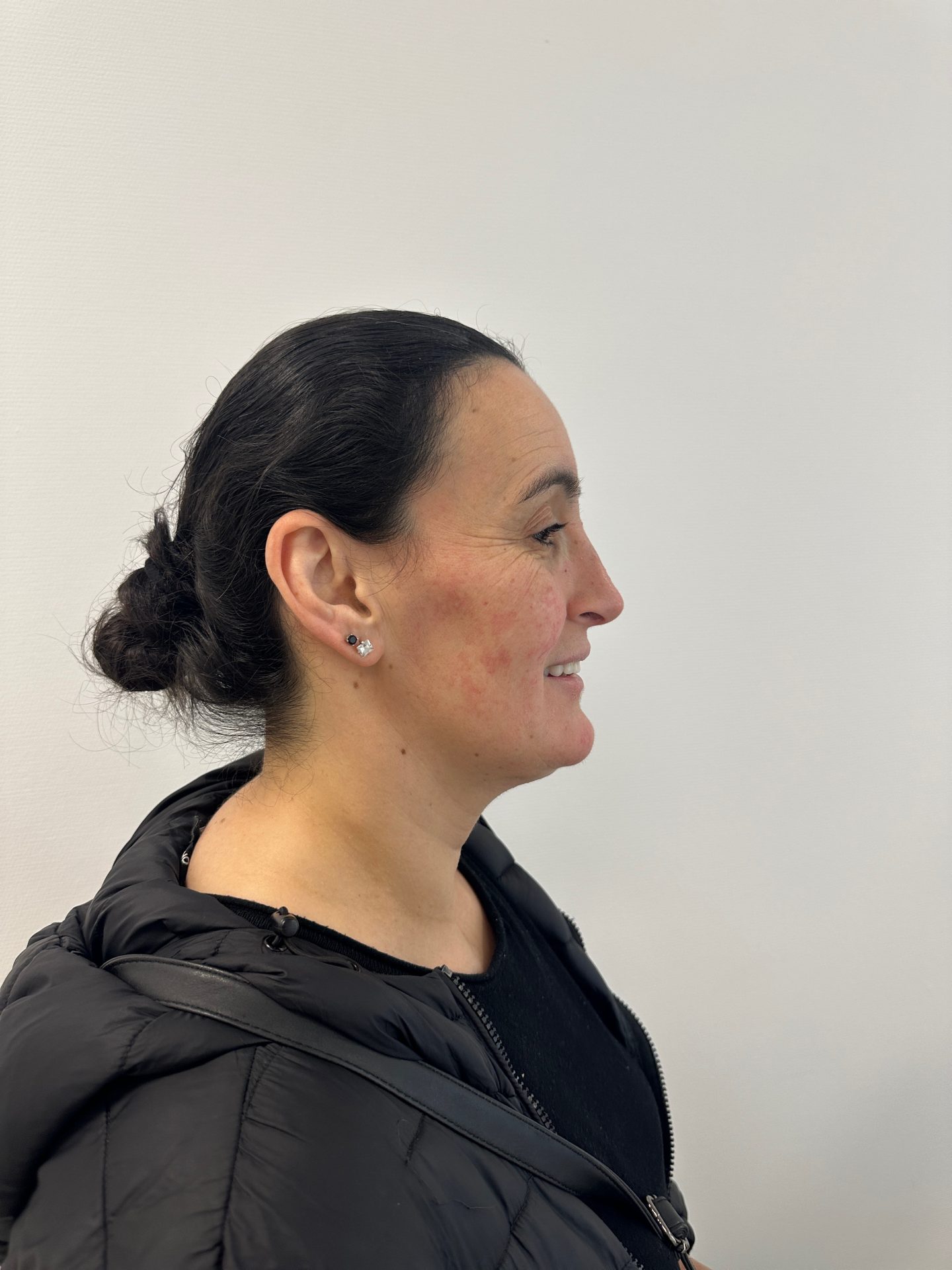 Nose correction after