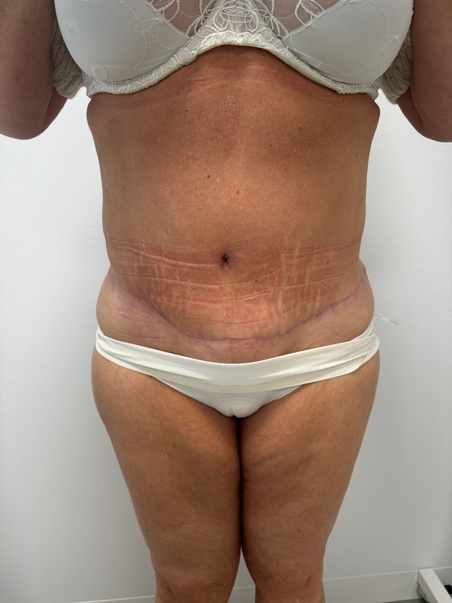 Tummy tuck after