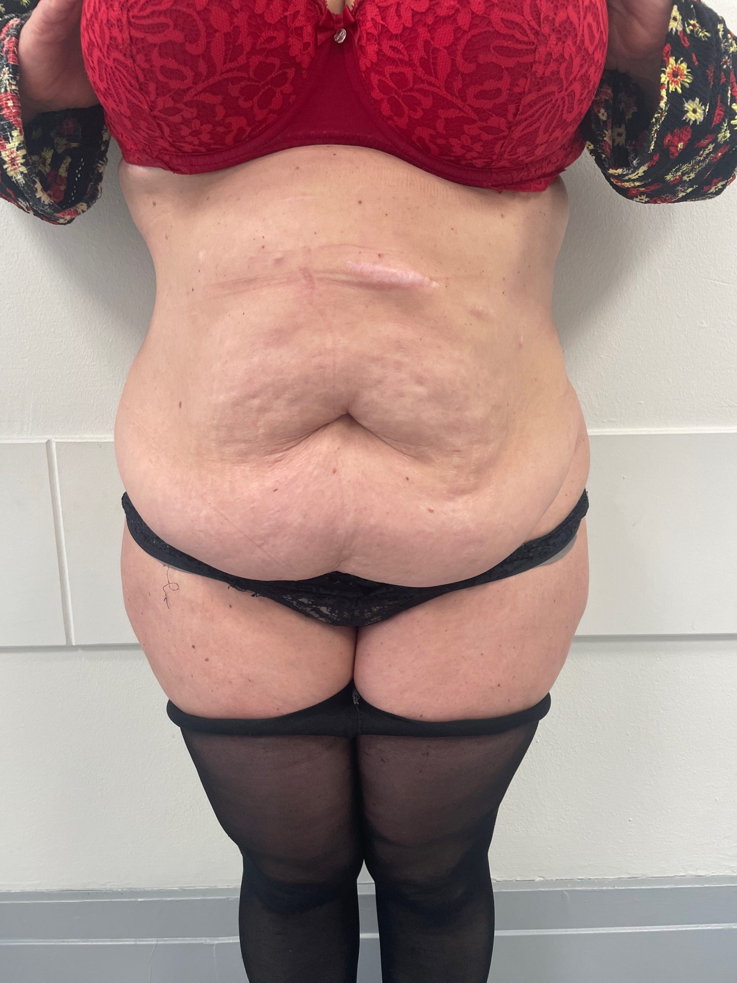 Tummy tuck before