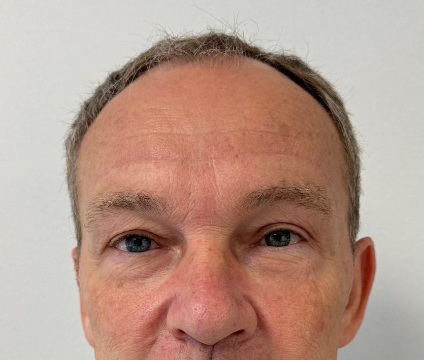 Eyelid correction after
