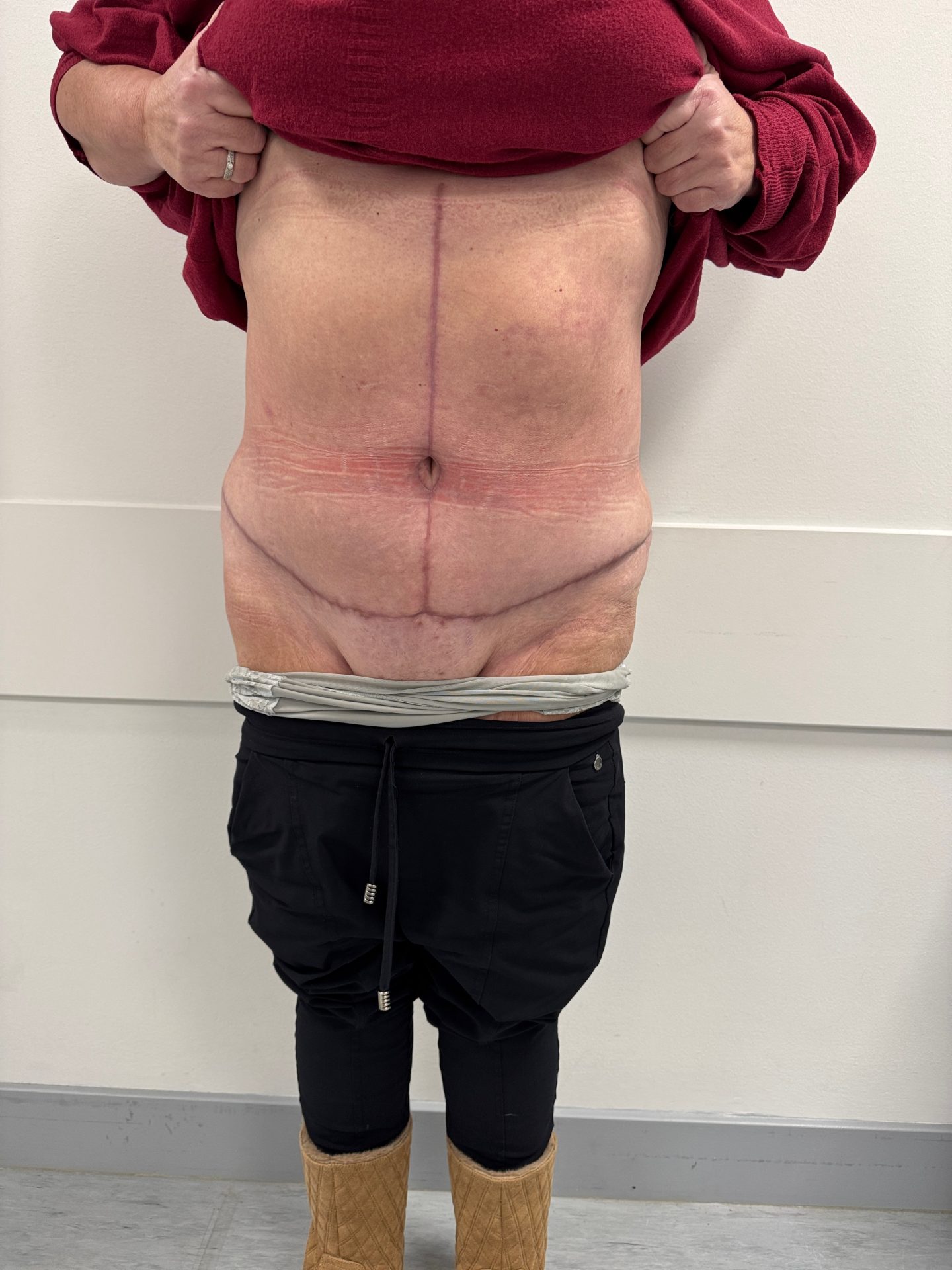 Tummy tuck after