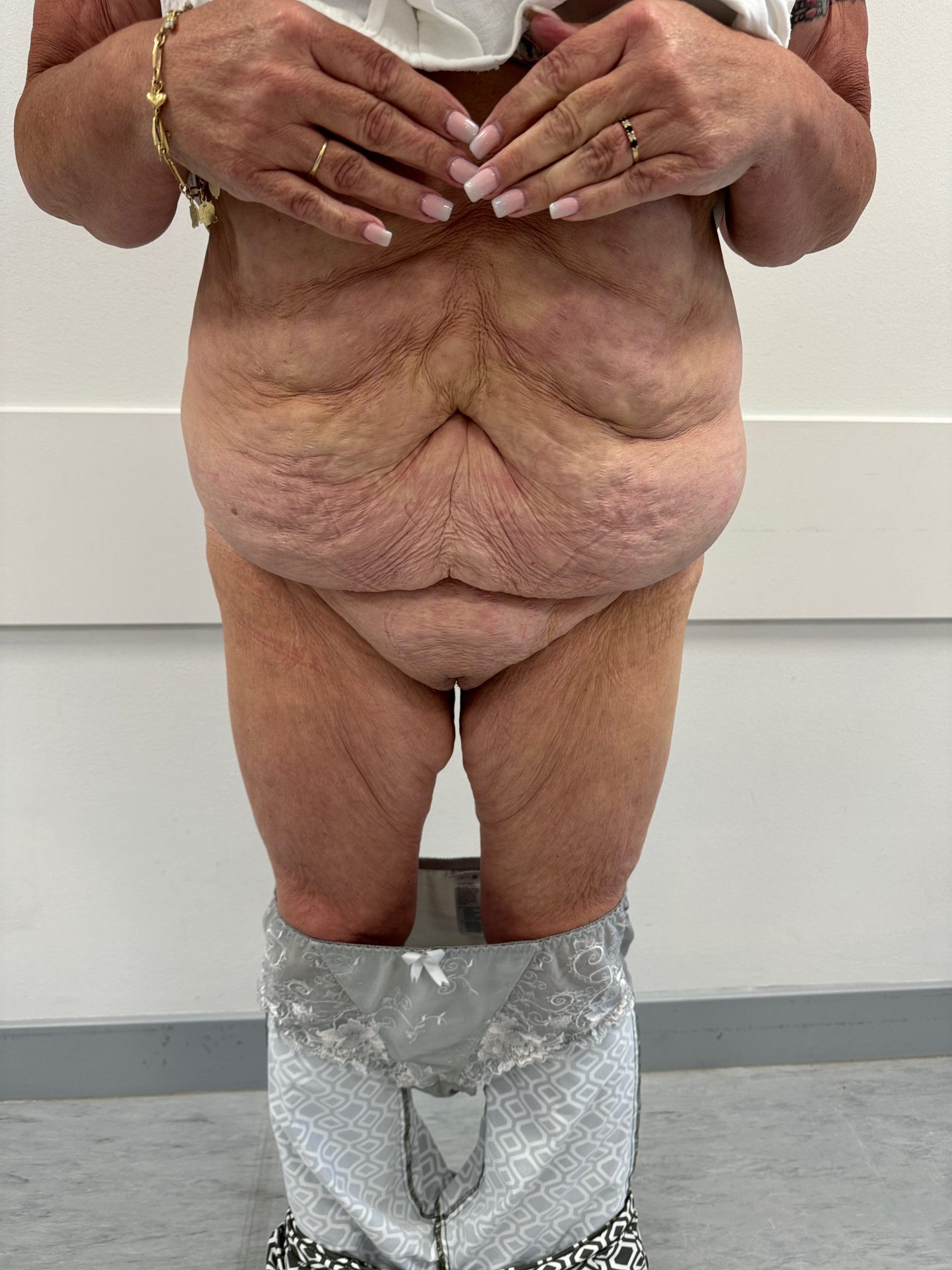 Tummy tuck before